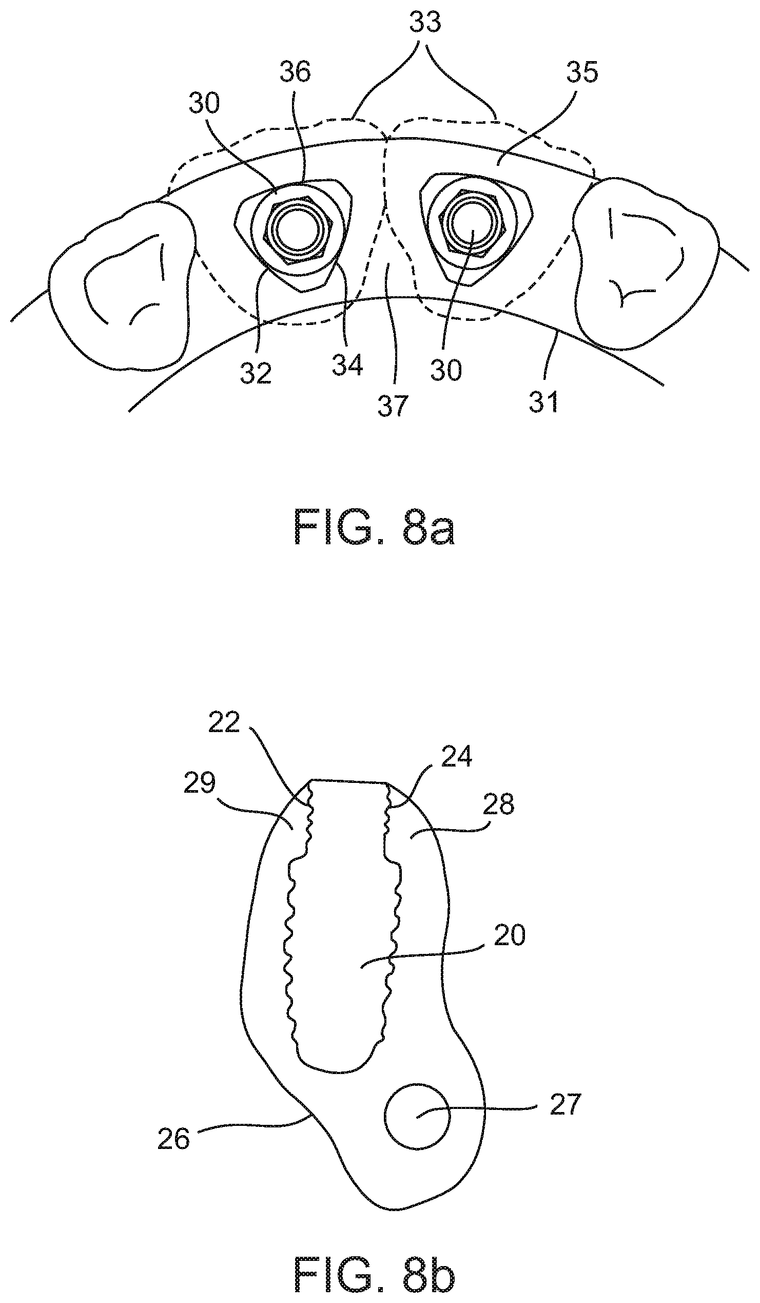 Patent US12167950 Figure 6 – Dental implant