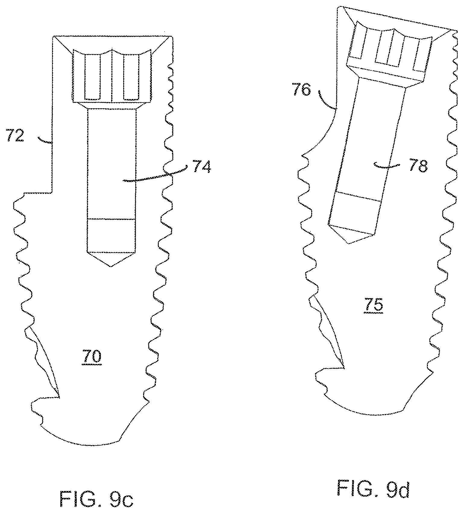 Patent US12167950 Figure 9 – Dental implant