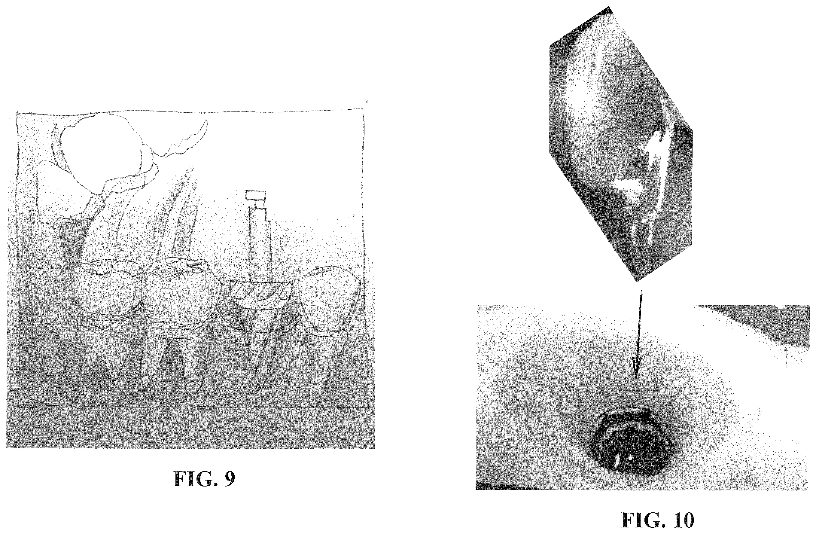 Patent US12167951 Figure 4 – Osteotomy drill bit to produce an optimally shaped jawbone opening for a dental implant and abutment