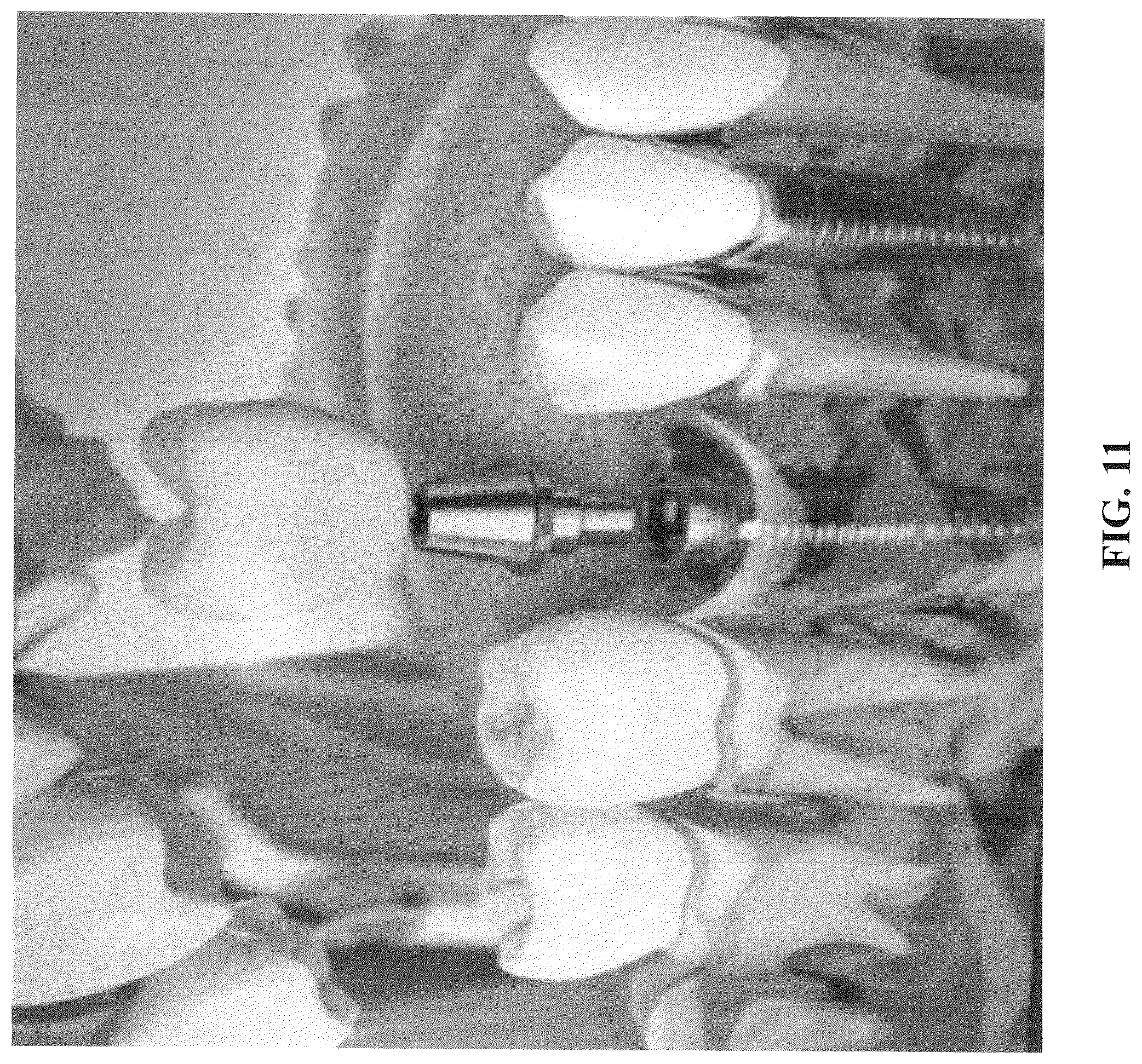 Patent US12167951 Figure 5 – Osteotomy drill bit to produce an optimally shaped jawbone opening for a dental implant and abutment