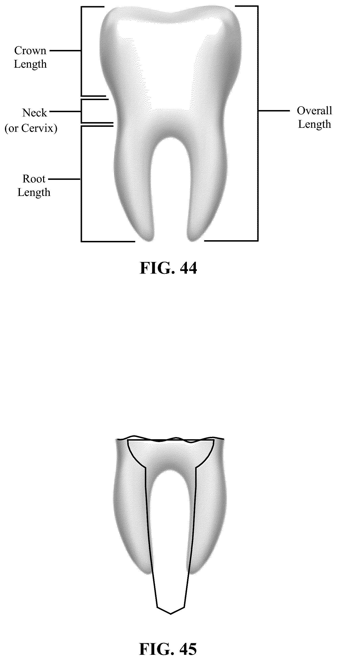 Patent US12167951 Figure 17 – Osteotomy drill bit to produce an optimally shaped jawbone opening for a dental implant and abutment