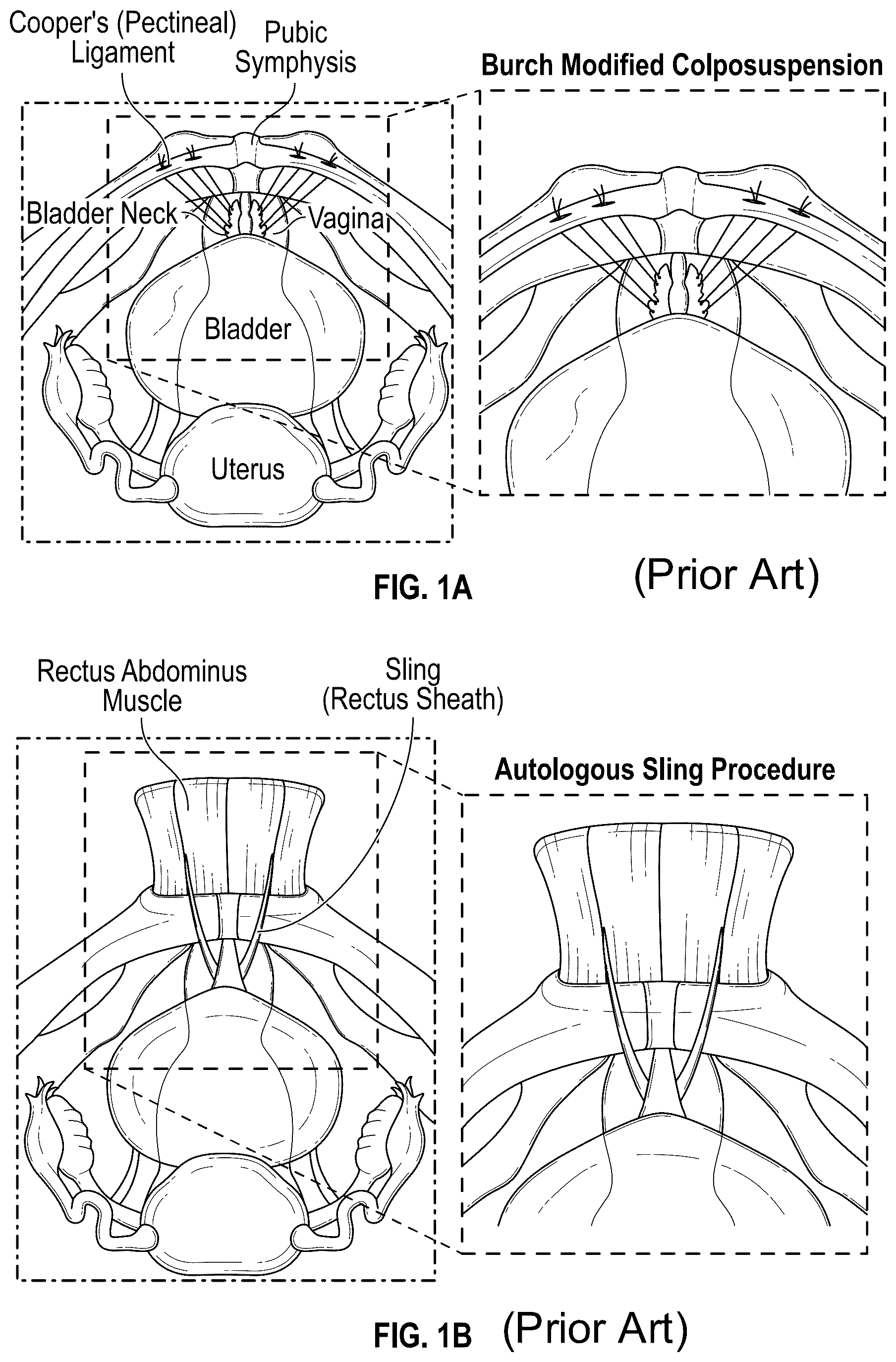 Patent US12167954 Figure 1 – Systems and methods for treating stress urinary incontinence