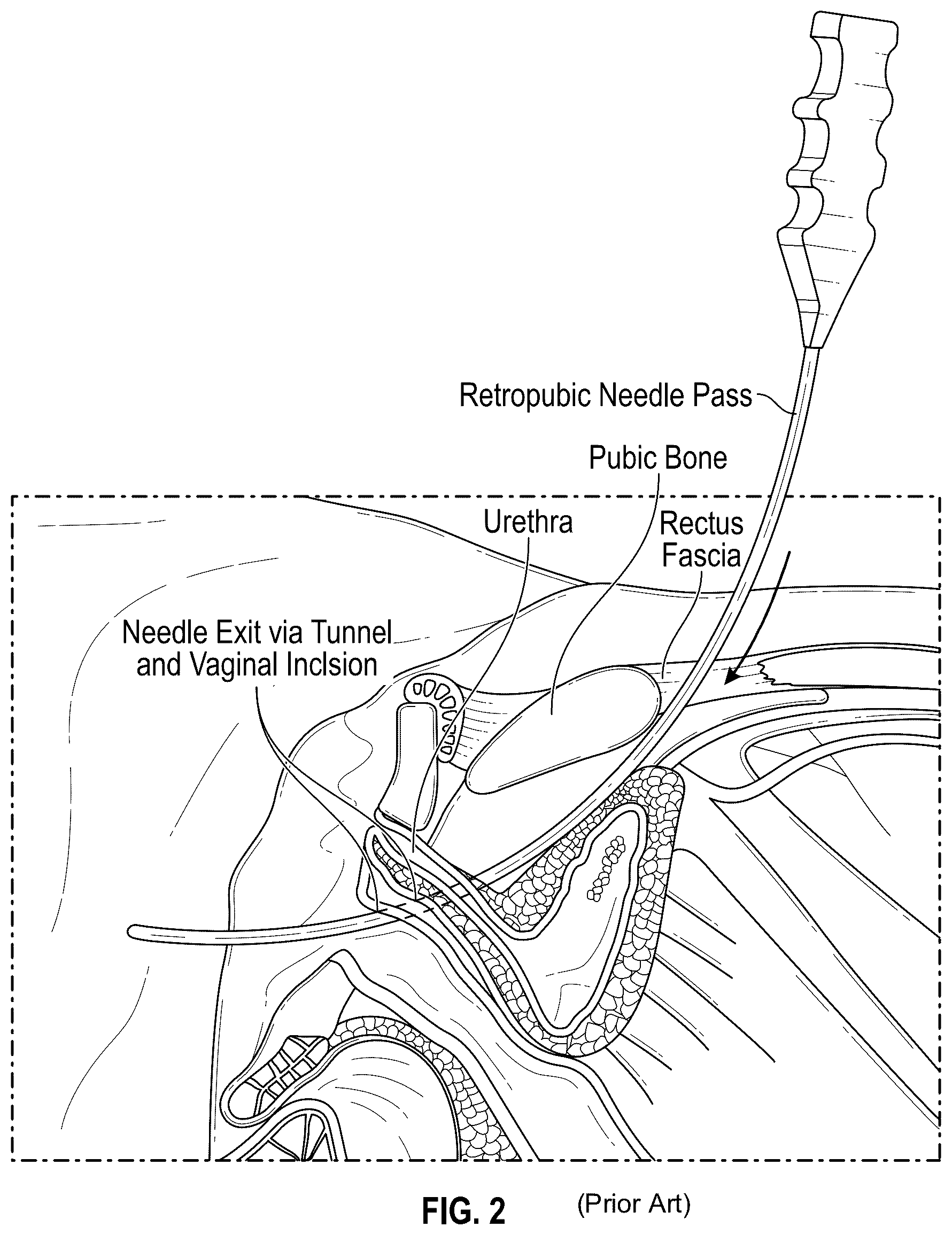 Patent US12167954 Figure 2 – Systems and methods for treating stress urinary incontinence