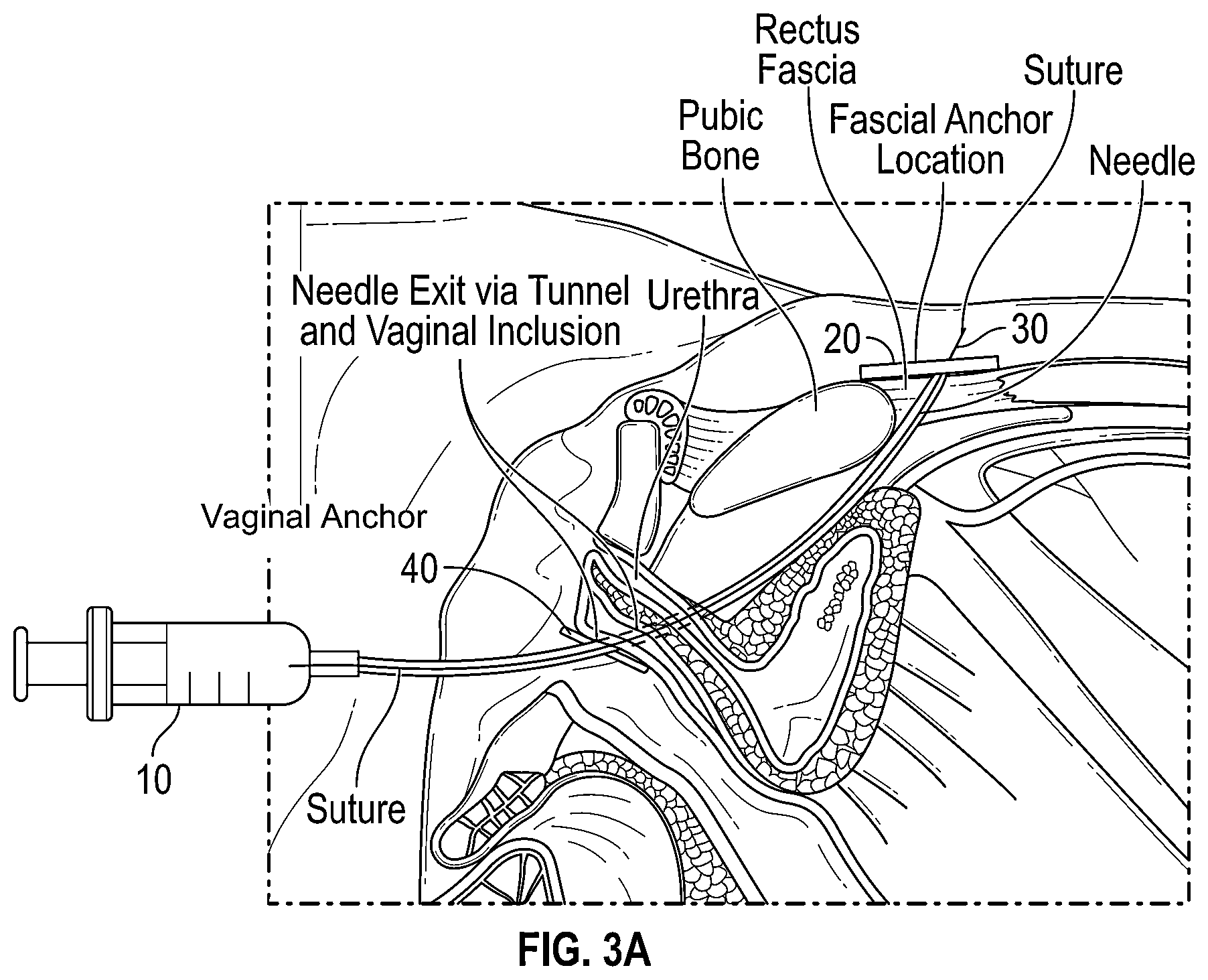 Patent US12167954 Figure 3 – Systems and methods for treating stress urinary incontinence