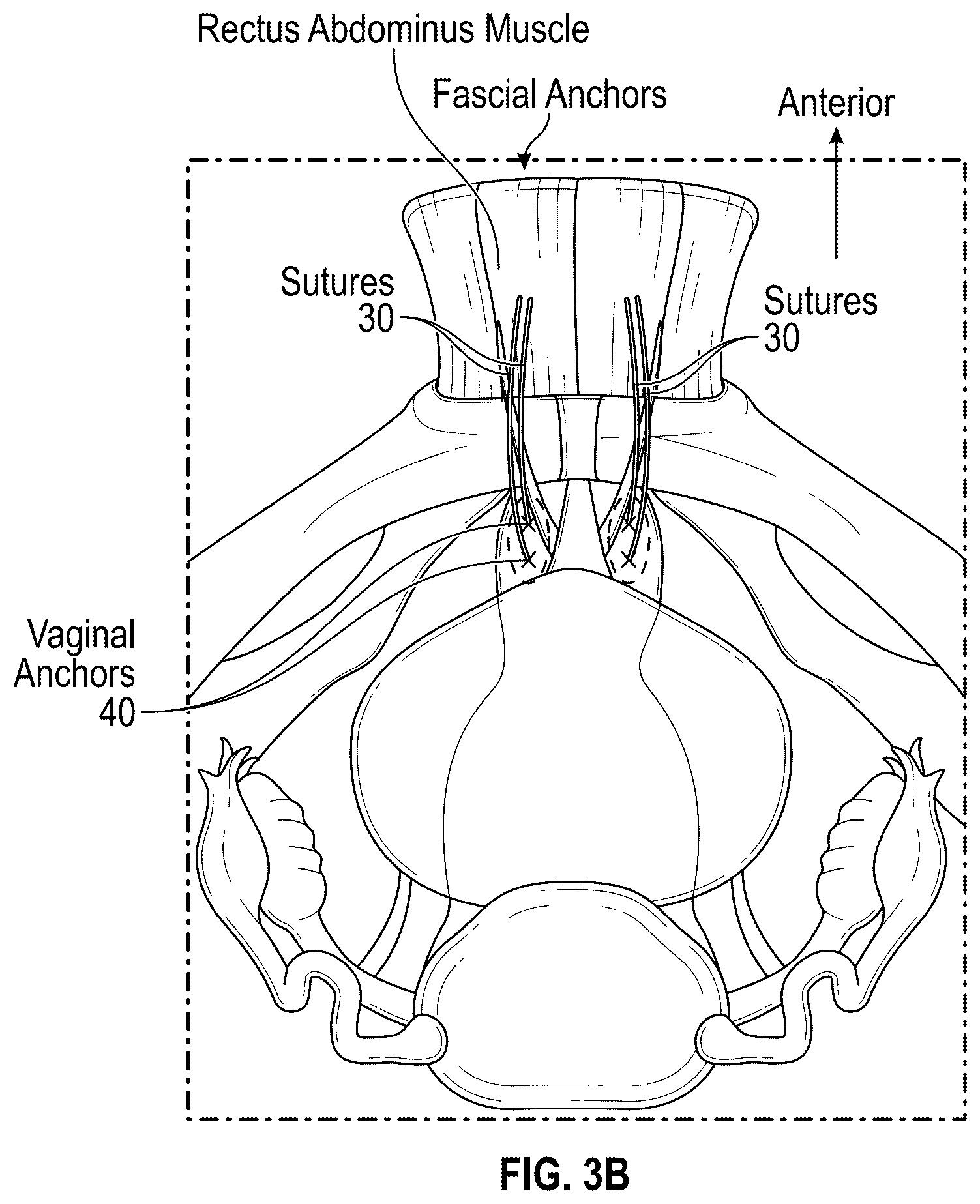 Patent US12167954 Figure 4 – Systems and methods for treating stress urinary incontinence