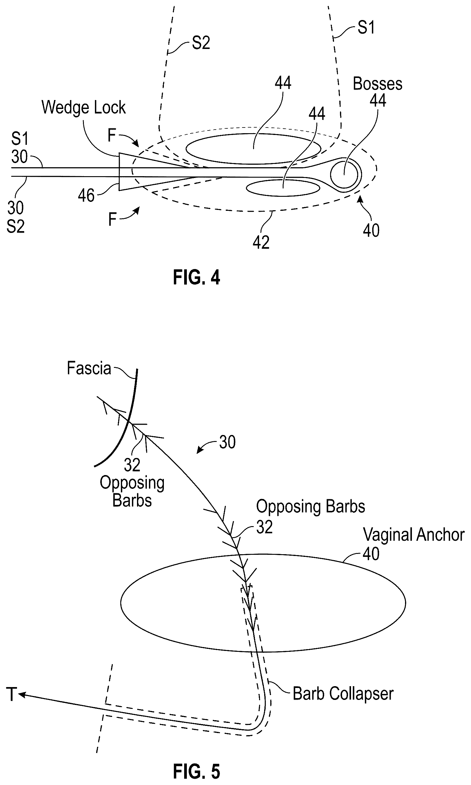 Patent US12167954 Figure 5 – Systems and methods for treating stress urinary incontinence
