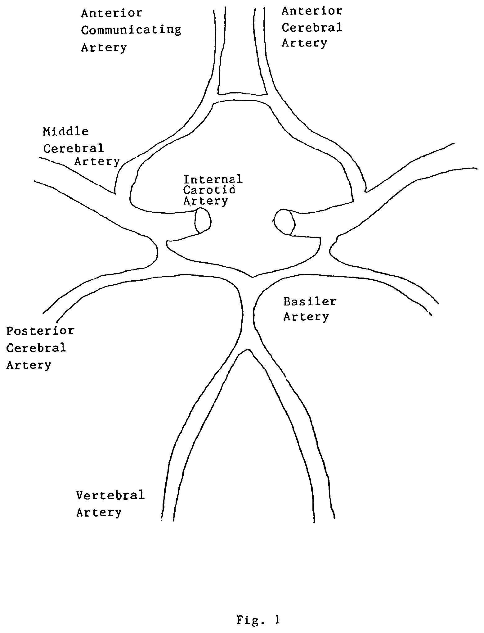 Patent US12167956 Figure 1 – Lasso filter tipped microcatheter for simultaneous rotating separator, irrigator for thrombectomy and method for use