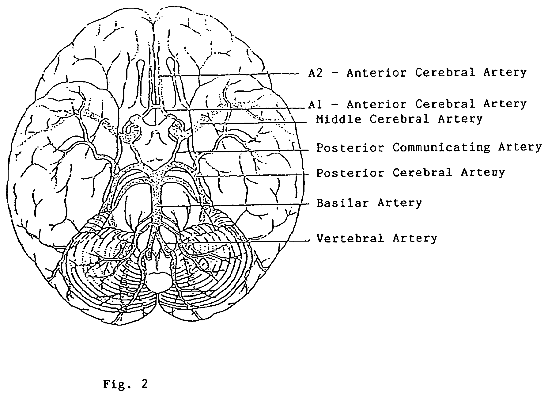 Patent US12167956 Figure 2 – Lasso filter tipped microcatheter for simultaneous rotating separator, irrigator for thrombectomy and method for use