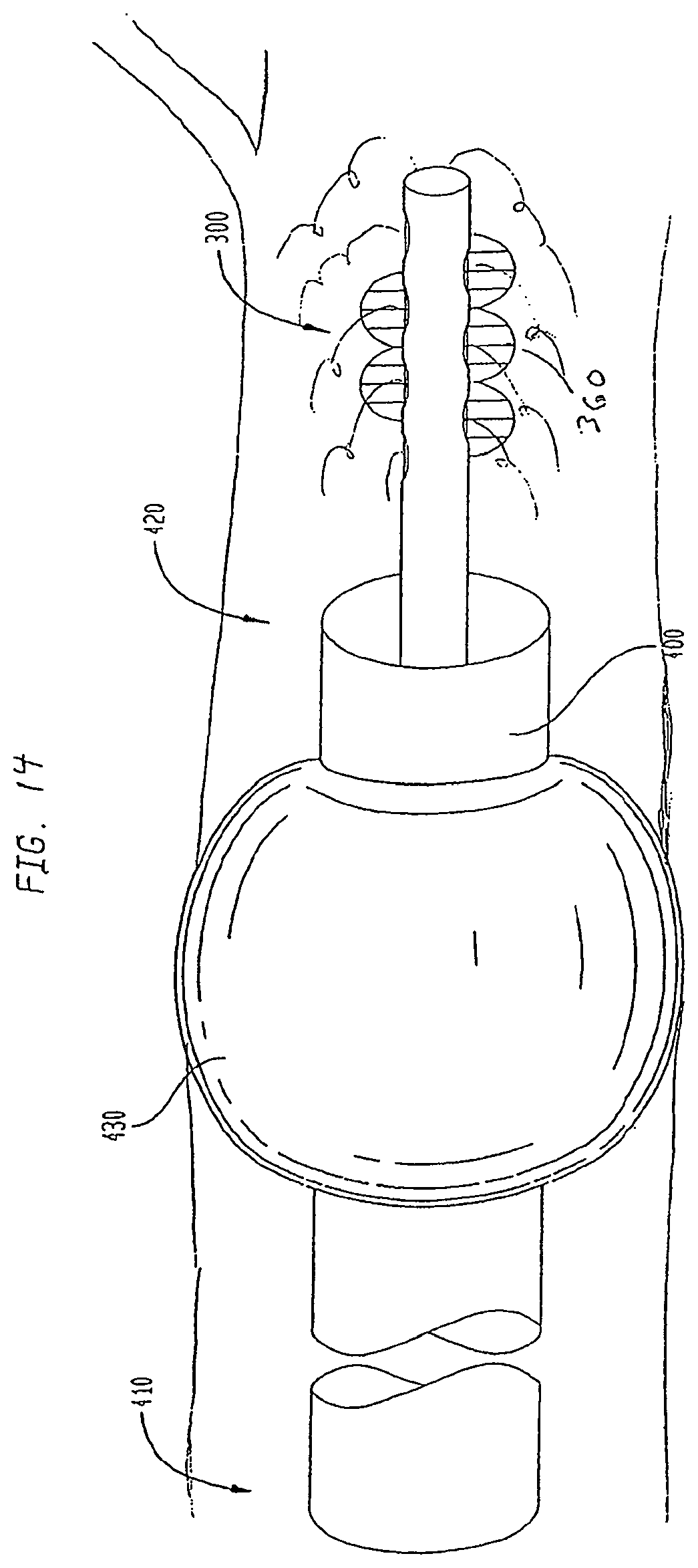 Patent US12167956 Figure 19 – Lasso filter tipped microcatheter for simultaneous rotating separator, irrigator for thrombectomy and method for use