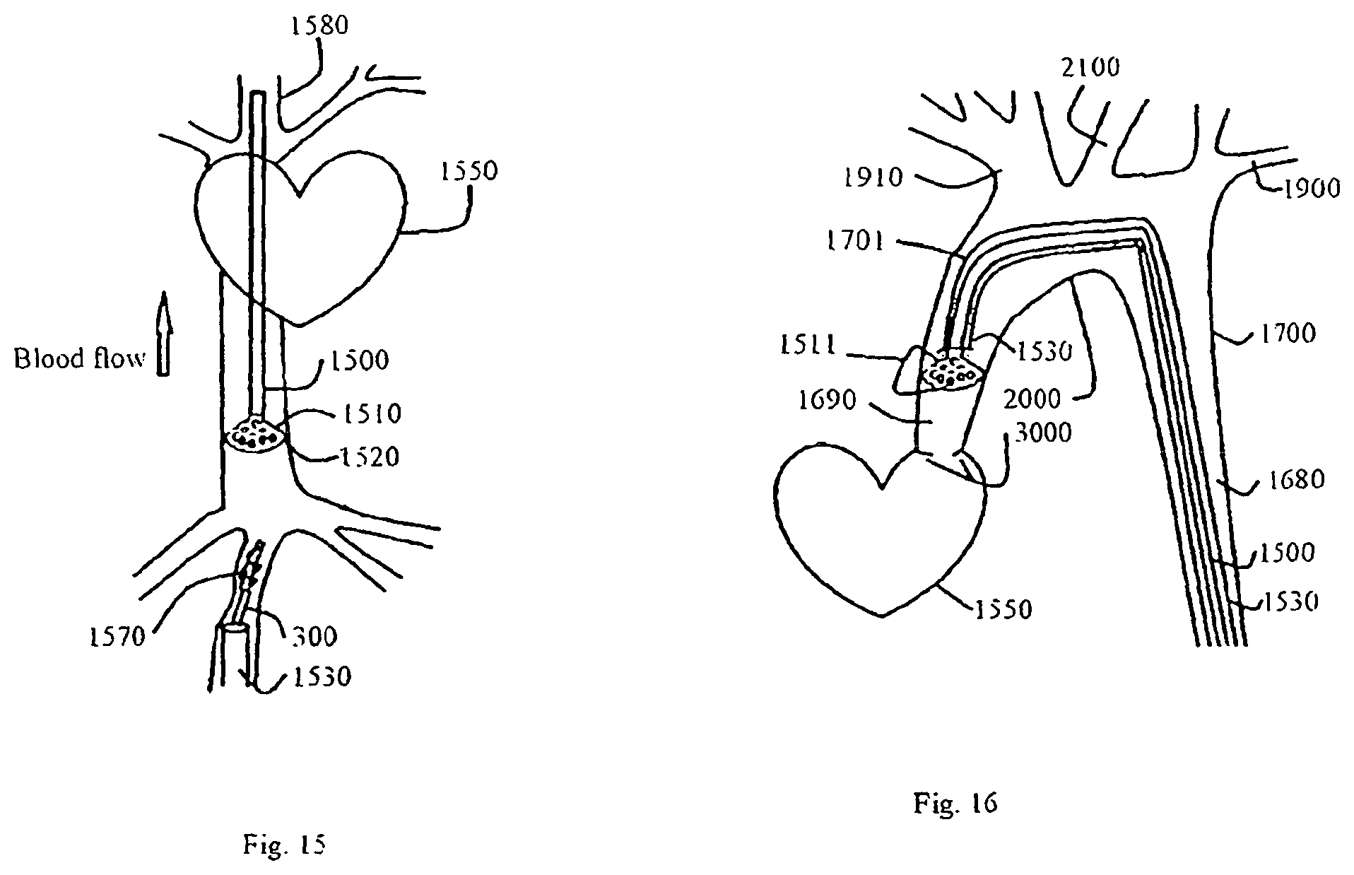 Patent US12167956 Figure 20 – Lasso filter tipped microcatheter for simultaneous rotating separator, irrigator for thrombectomy and method for use