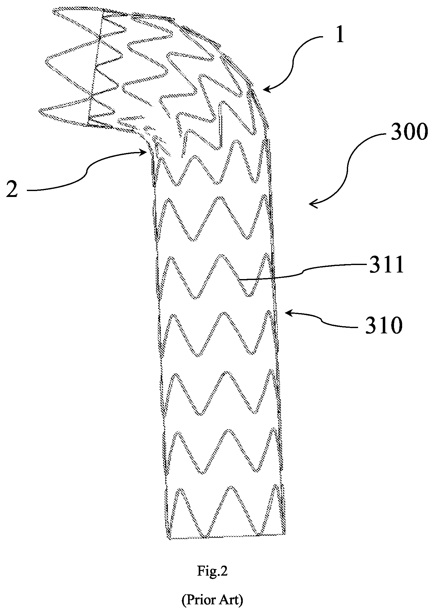 Patent US12167957 Figure 2 – Stent graft