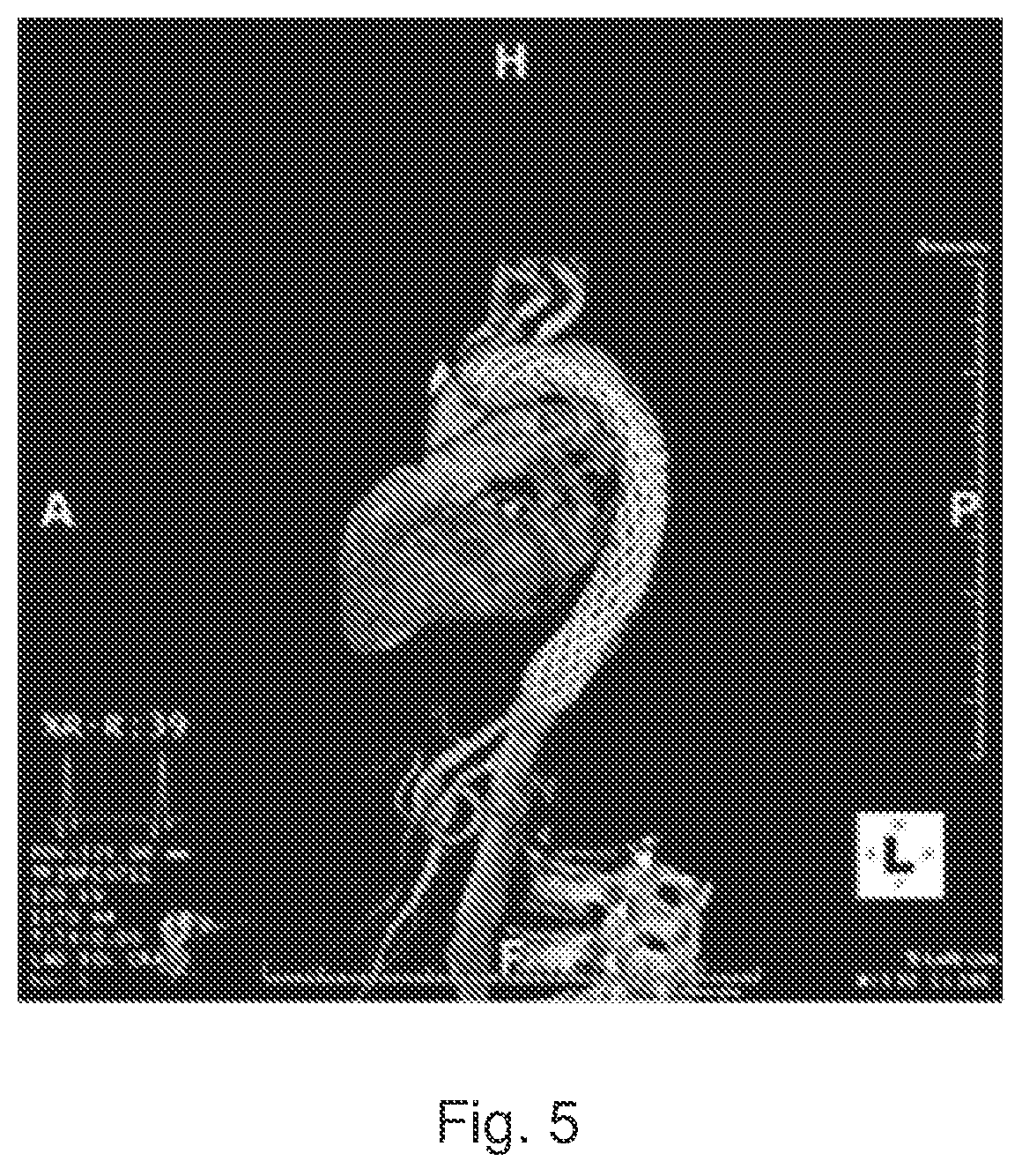 Patent US12167958 Figure 6 – Multi-spiral self-expanding stent and methods of making and using the same