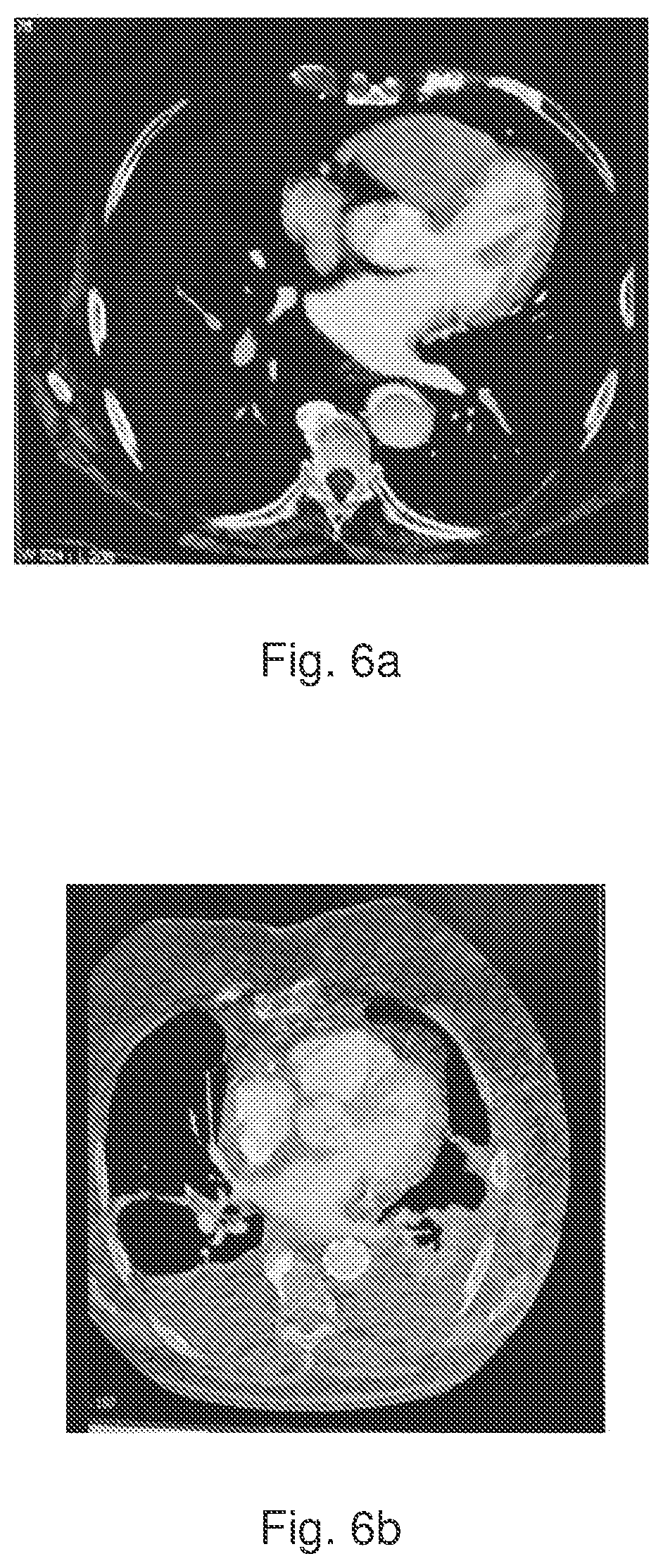 Patent US12167958 Figure 7 – Multi-spiral self-expanding stent and methods of making and using the same