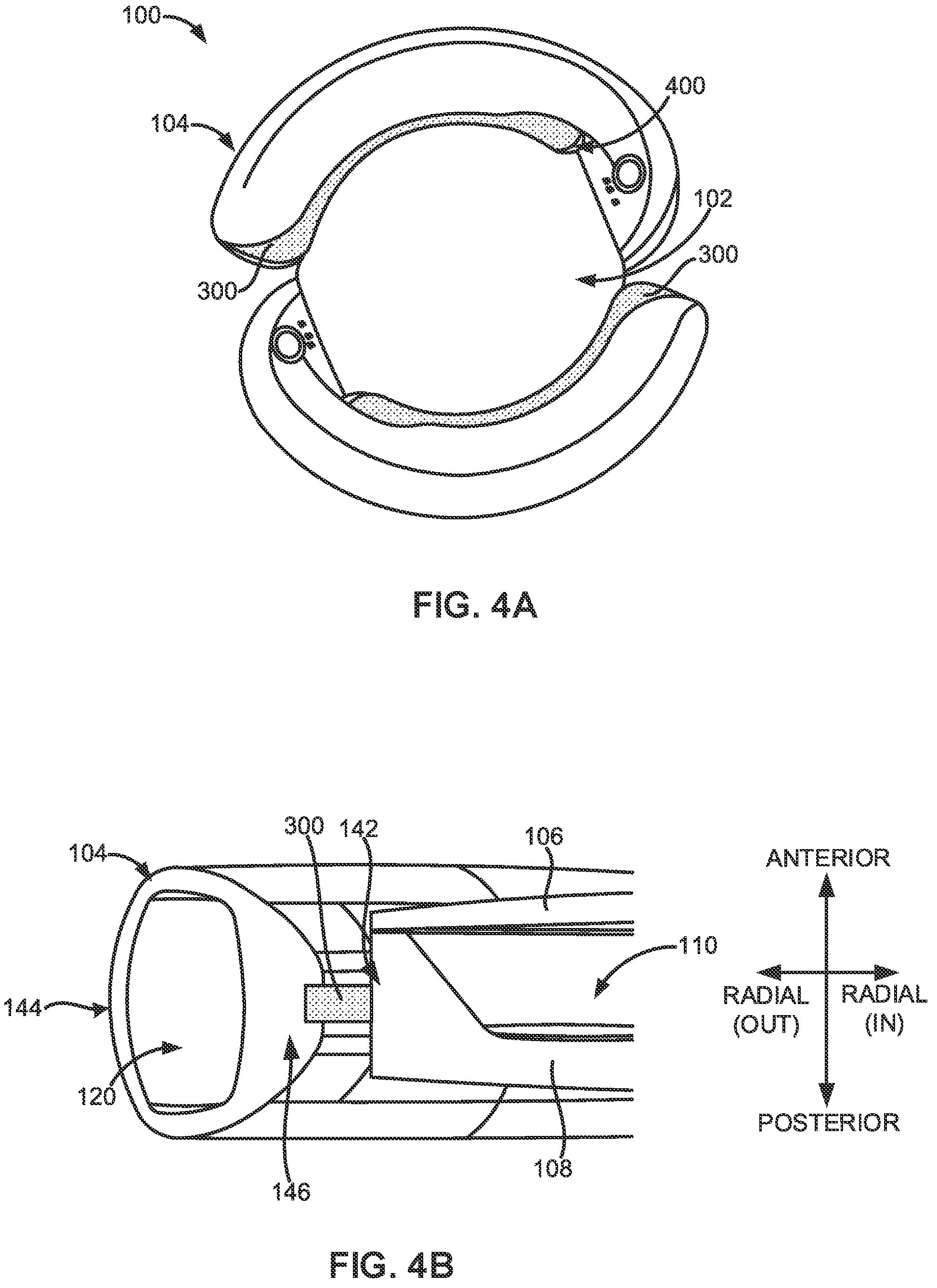 Patent US12167959 Figure 6 – Adjustable intraocular lenses and methods of post-operatively adjusting intraocular lenses