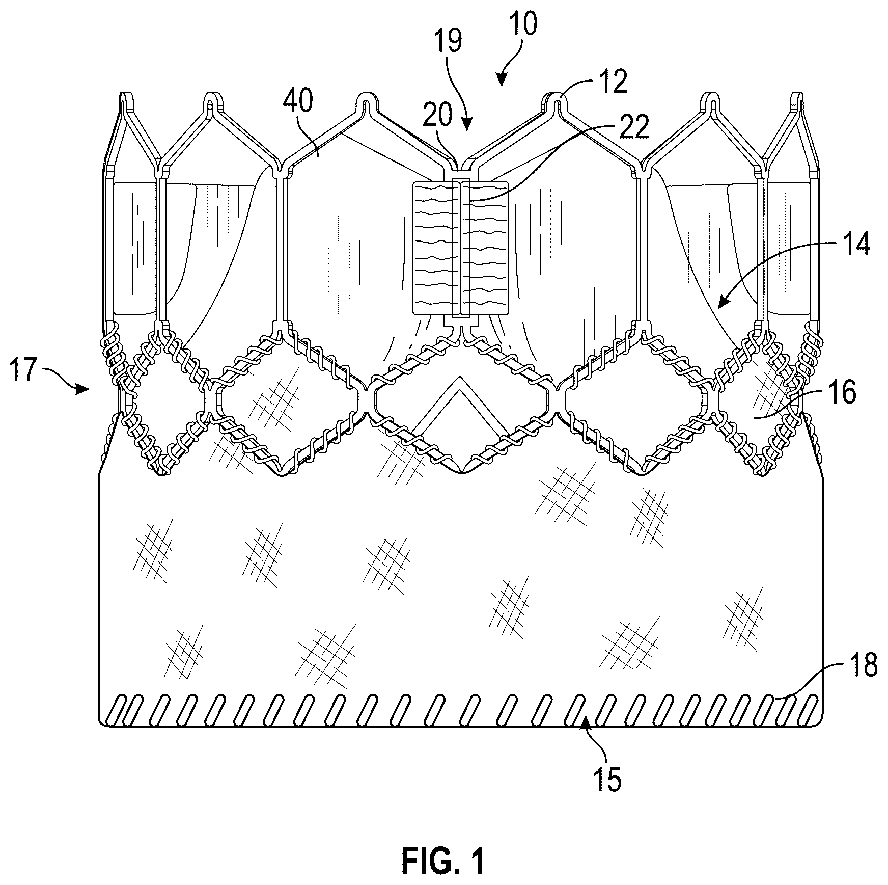Patent US12167961 Figure 1 – Methods and systems for aligning a commissure of a prosthetic heart valve with a commissure of a native valve