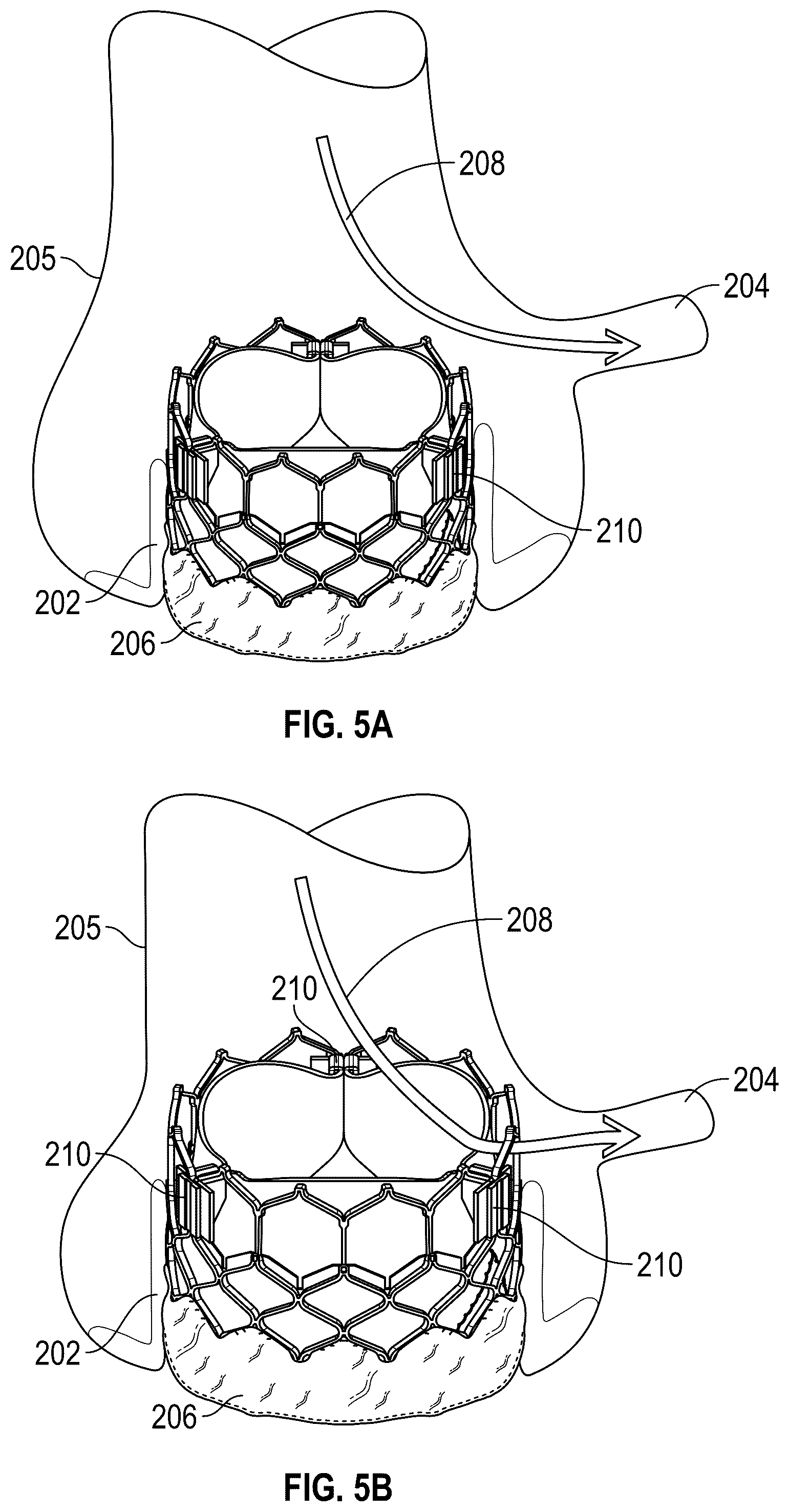Patent US12167961 Figure 4 – Methods and systems for aligning a commissure of a prosthetic heart valve with a commissure of a native valve