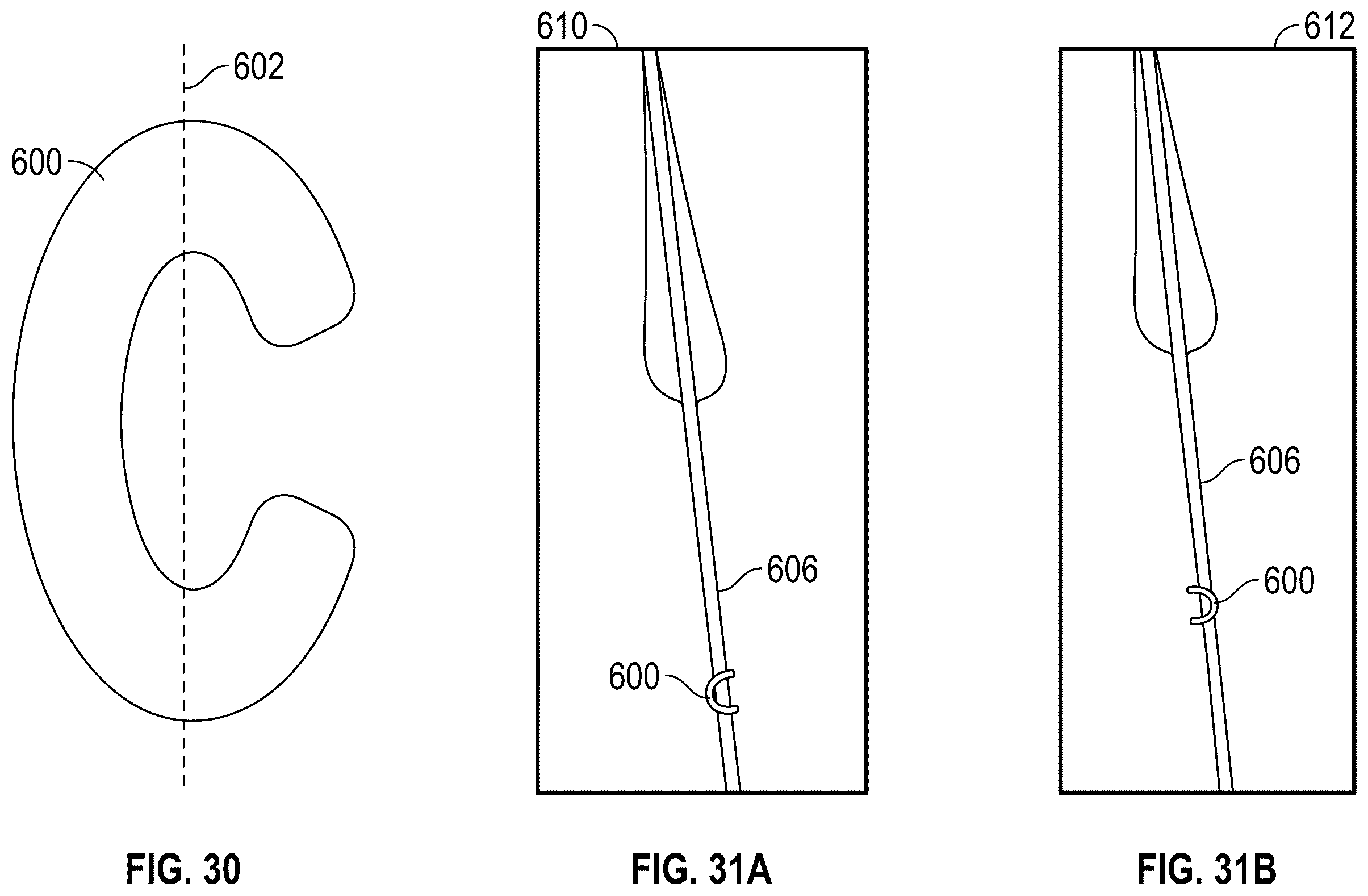 Patent US12167961 Figure 18 – Methods and systems for aligning a commissure of a prosthetic heart valve with a commissure of a native valve