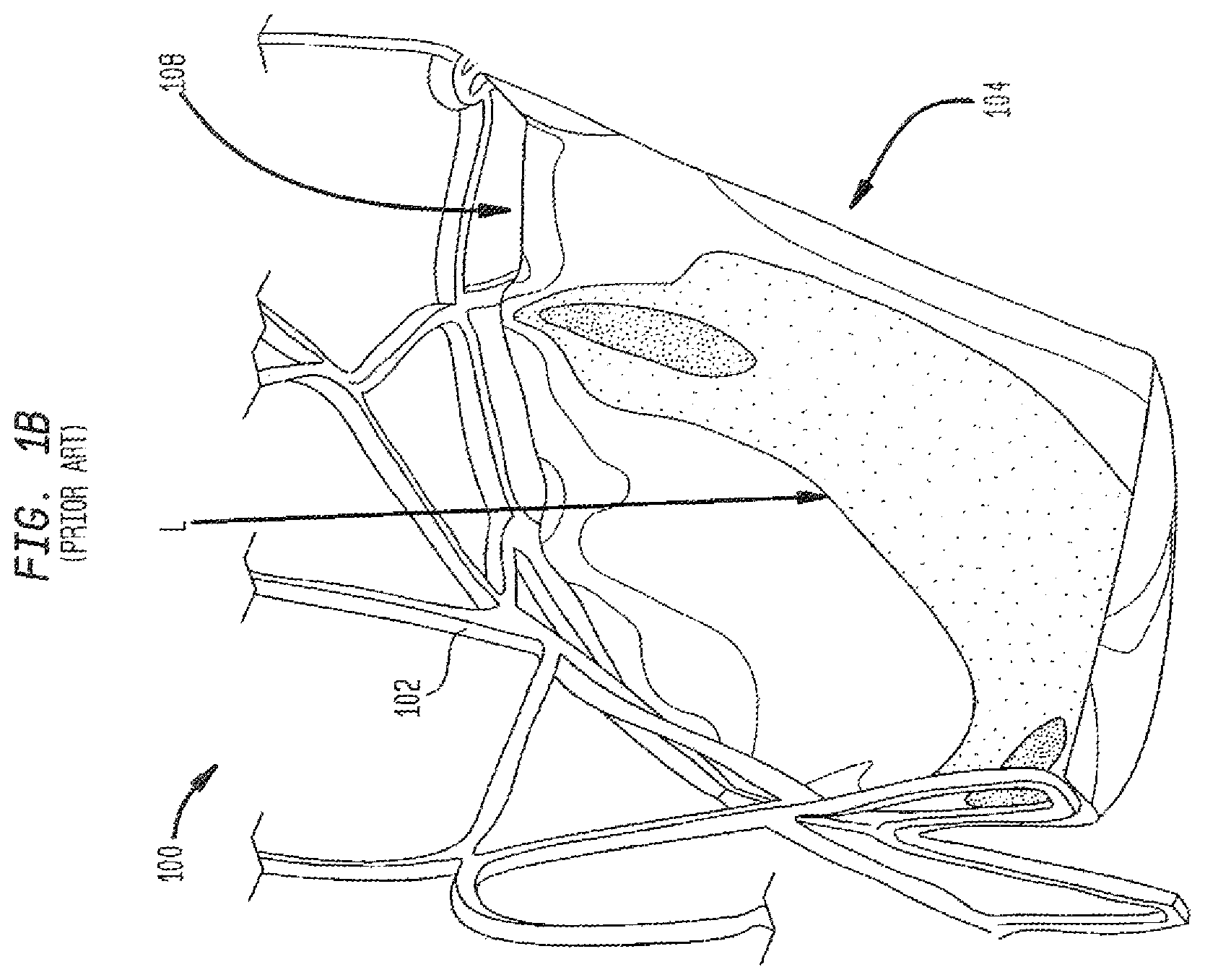 Patent US12167962 Figure 2 – Valve leaflet attachment in collapsible prosthetic valves