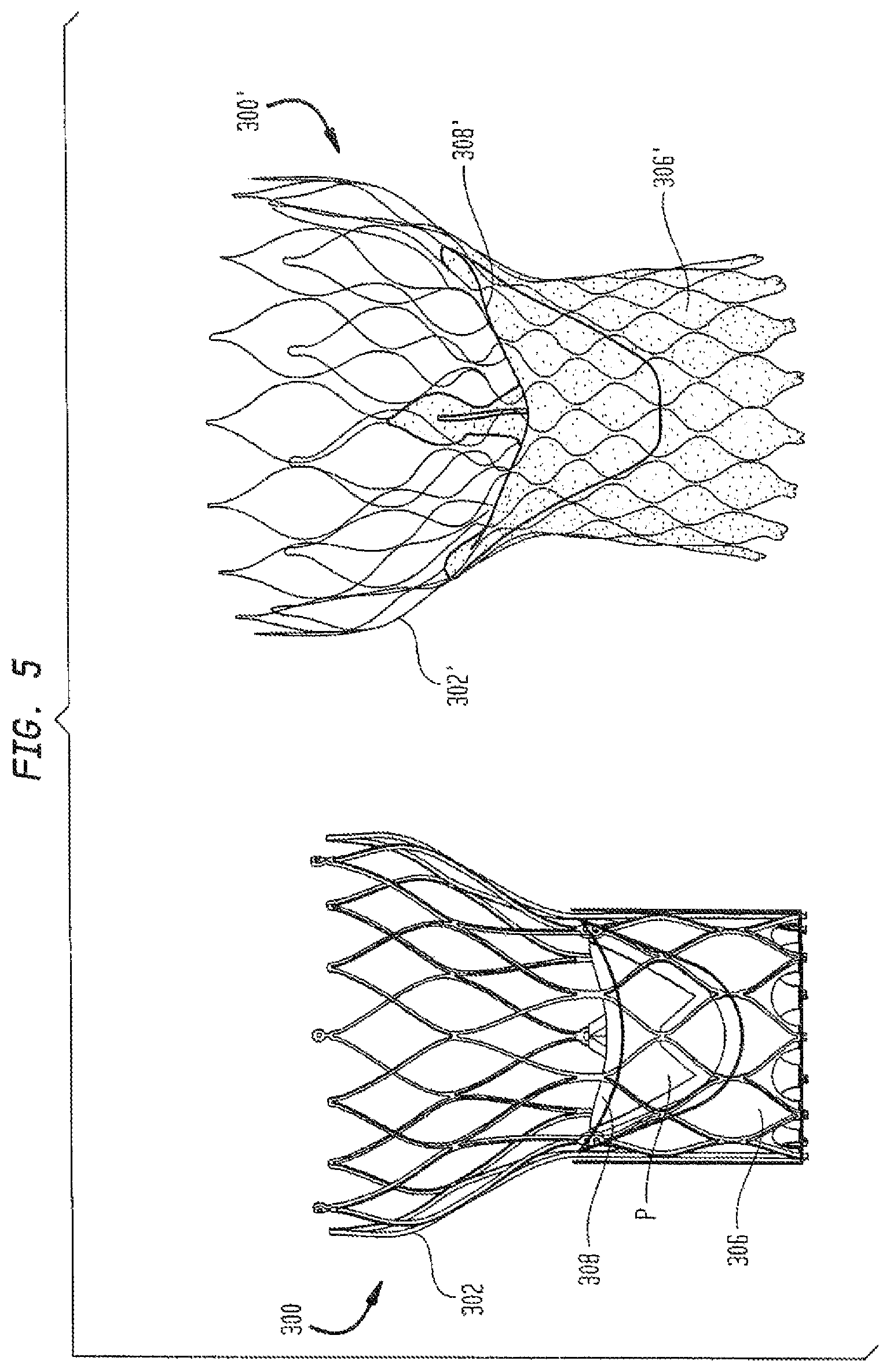 Patent US12167962 Figure 5 – Valve leaflet attachment in collapsible prosthetic valves