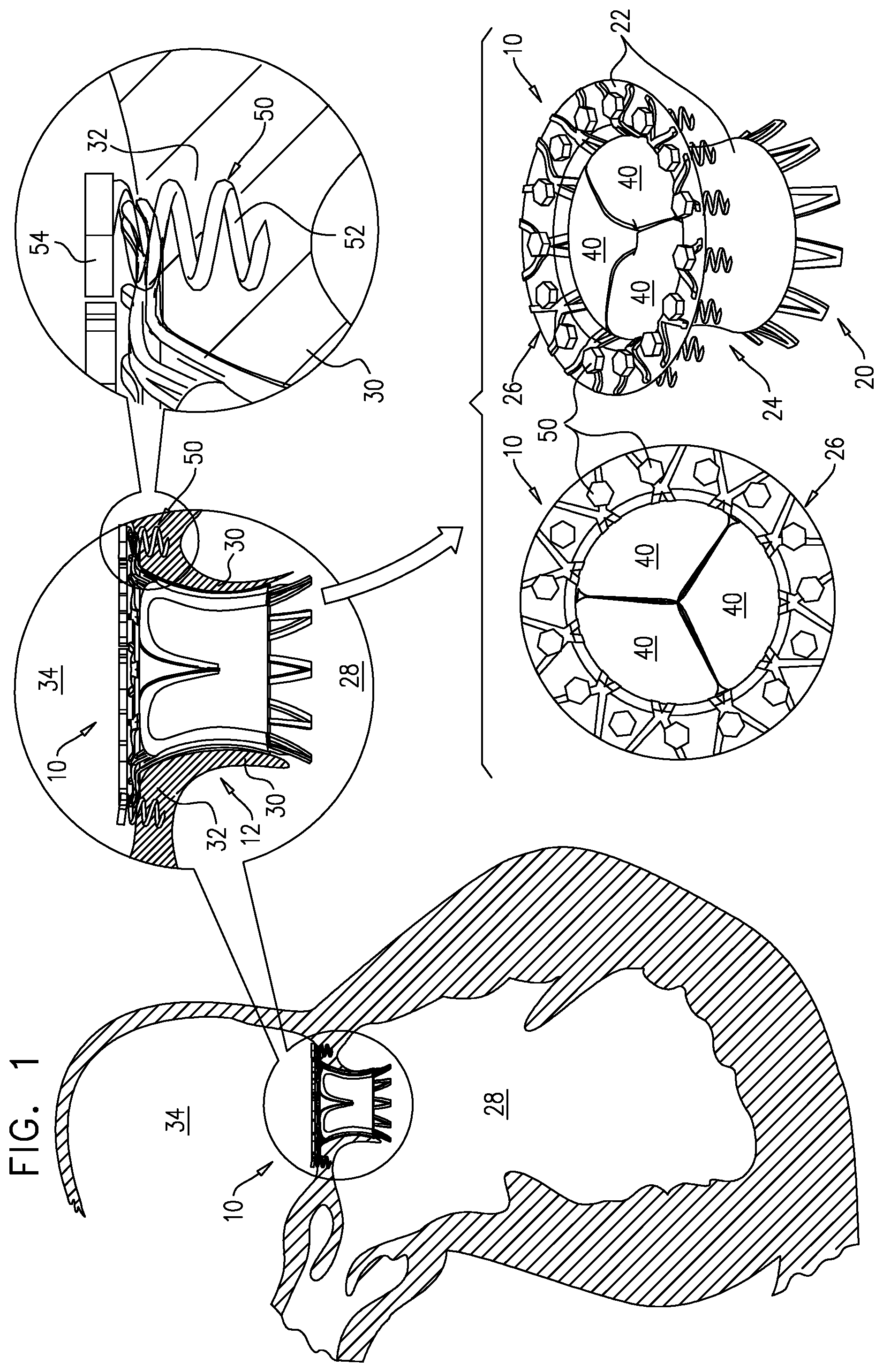 Patent US12167963 Figure 1 – Method for use at a heart valve