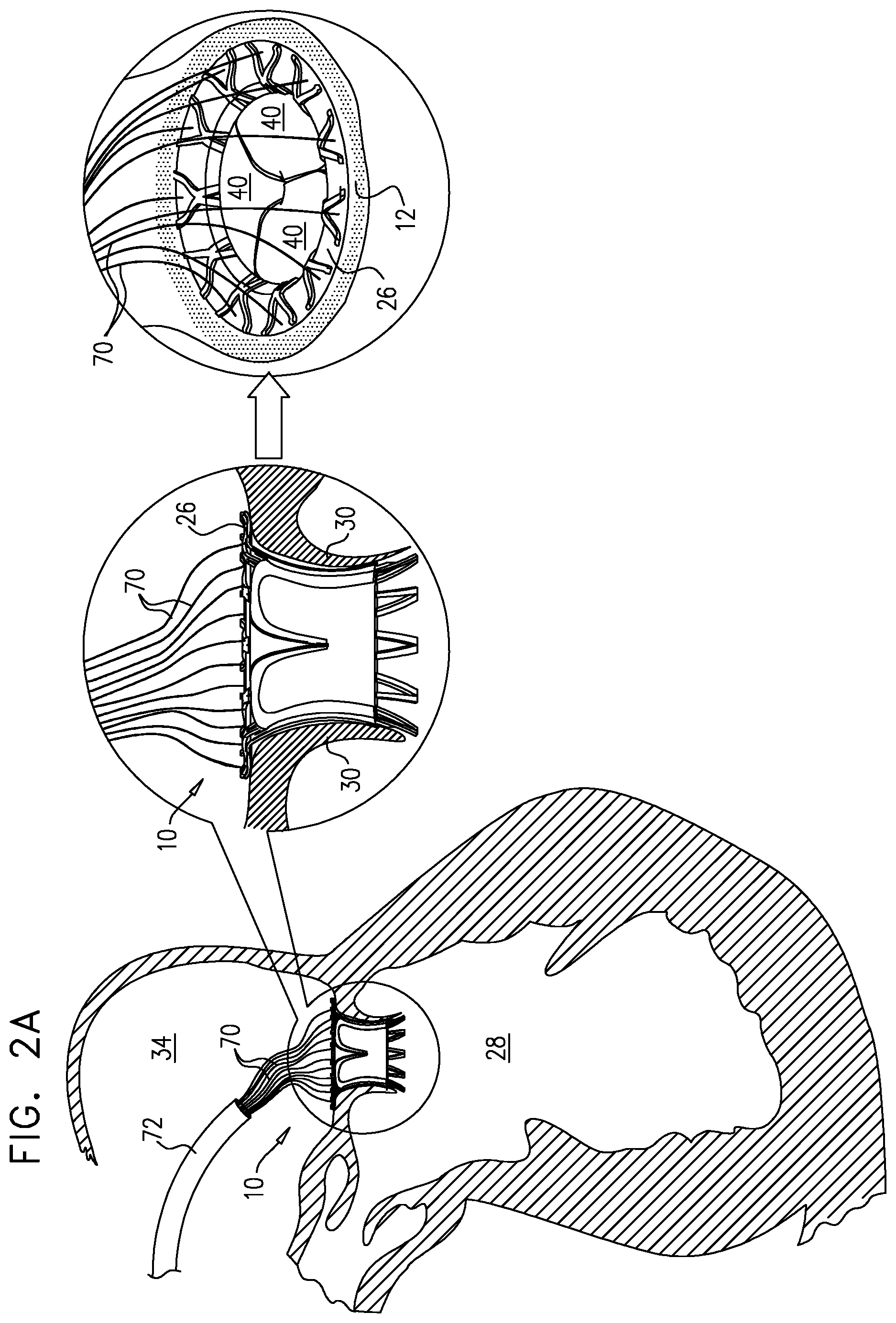 Patent US12167963 Figure 2 – Method for use at a heart valve