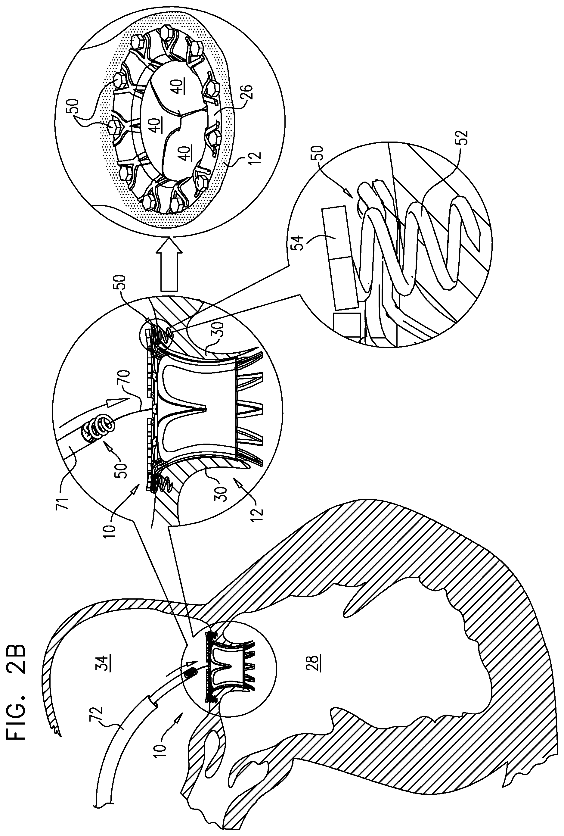 Patent US12167963 Figure 3 – Method for use at a heart valve