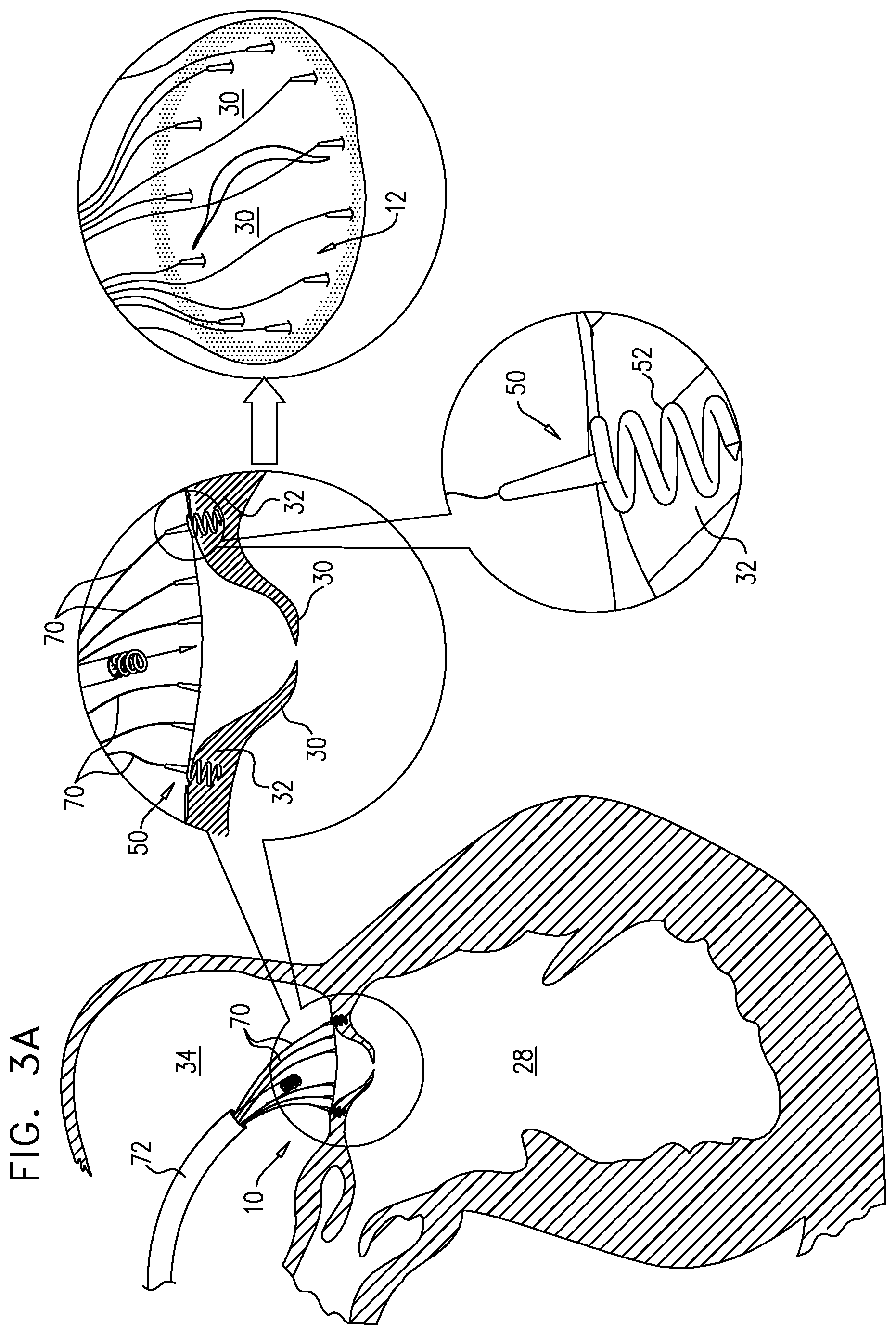 Patent US12167963 Figure 4 – Method for use at a heart valve