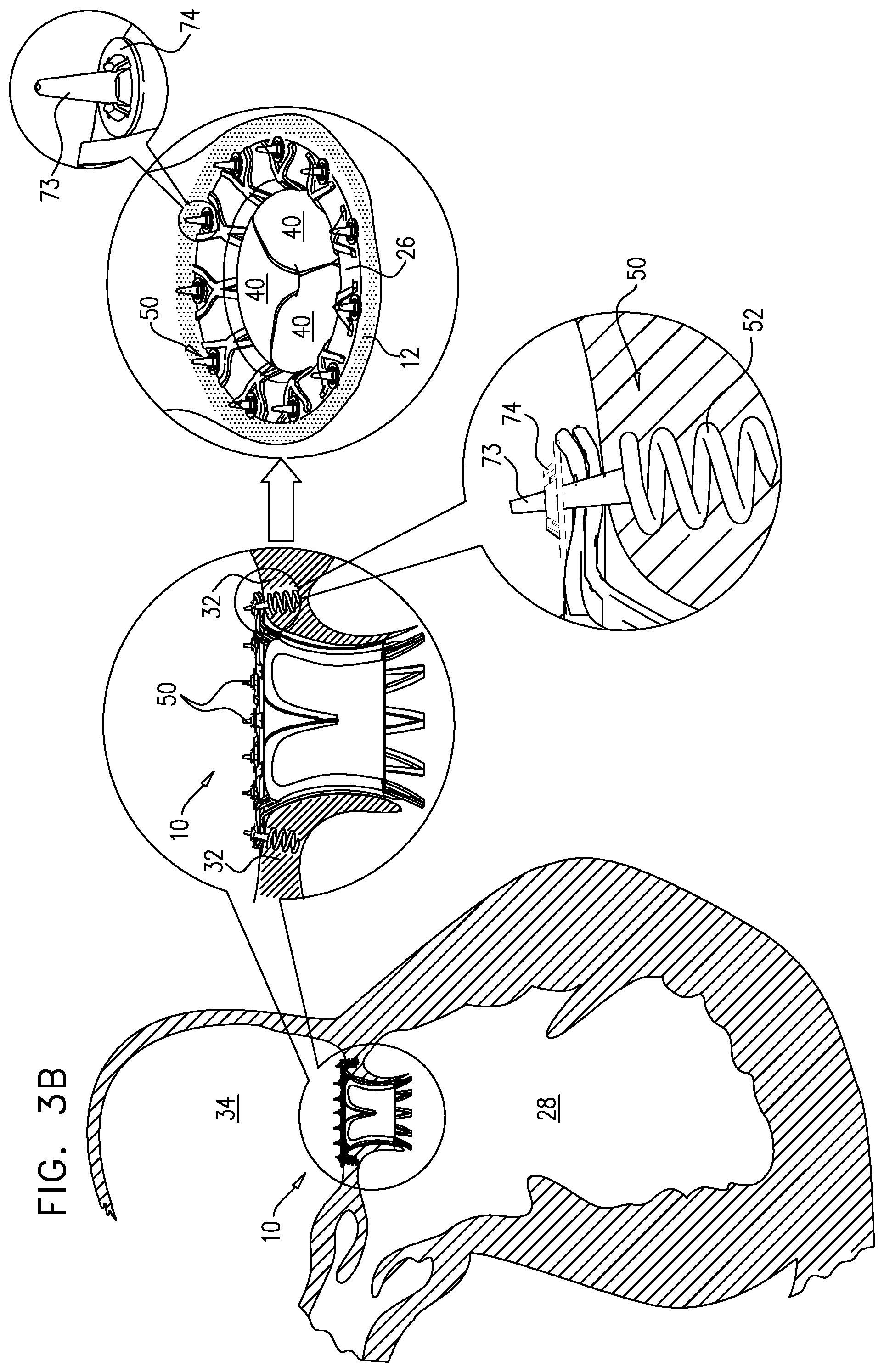 Patent US12167963 Figure 5 – Method for use at a heart valve