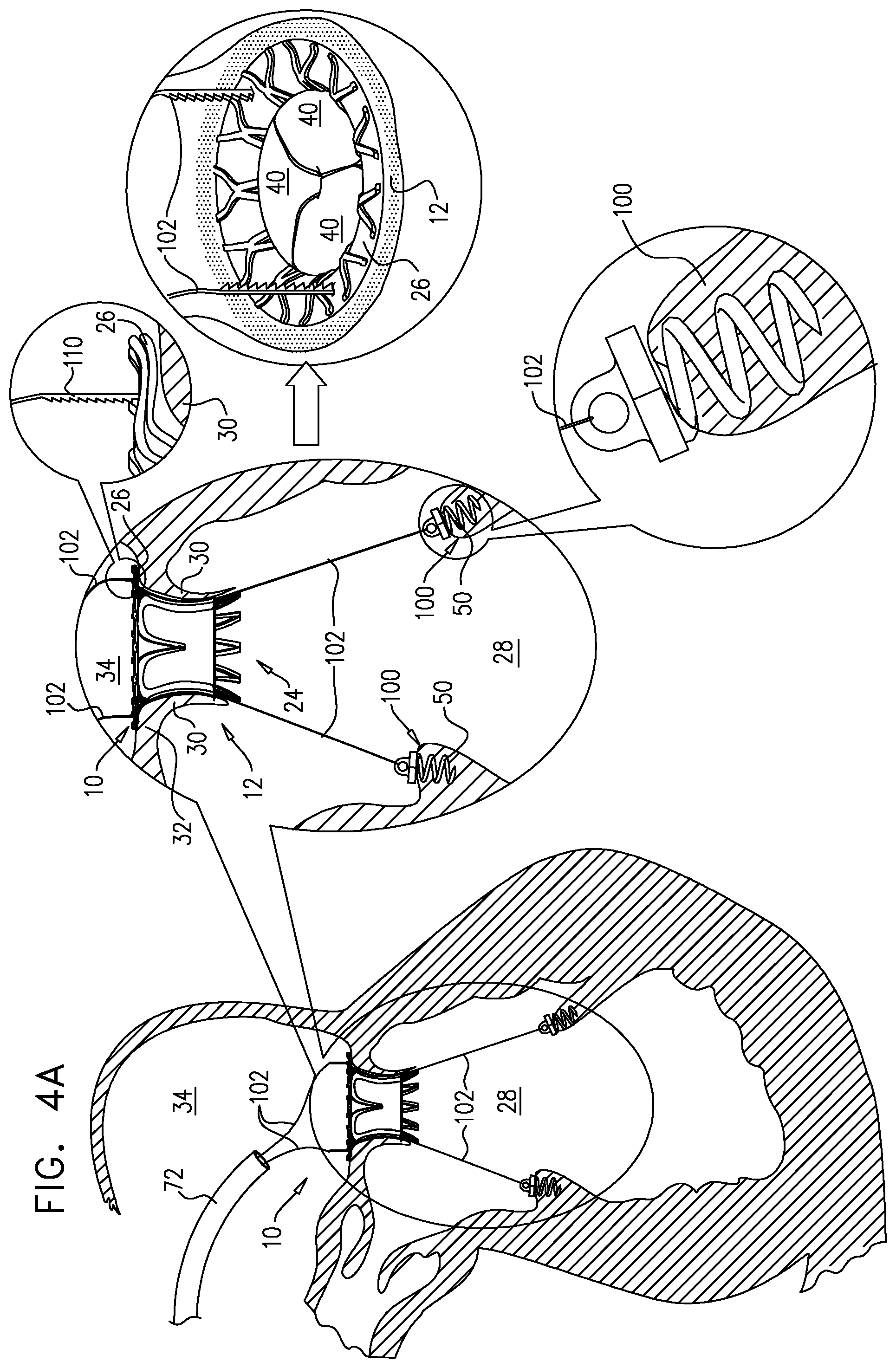 Patent US12167963 Figure 6 – Method for use at a heart valve