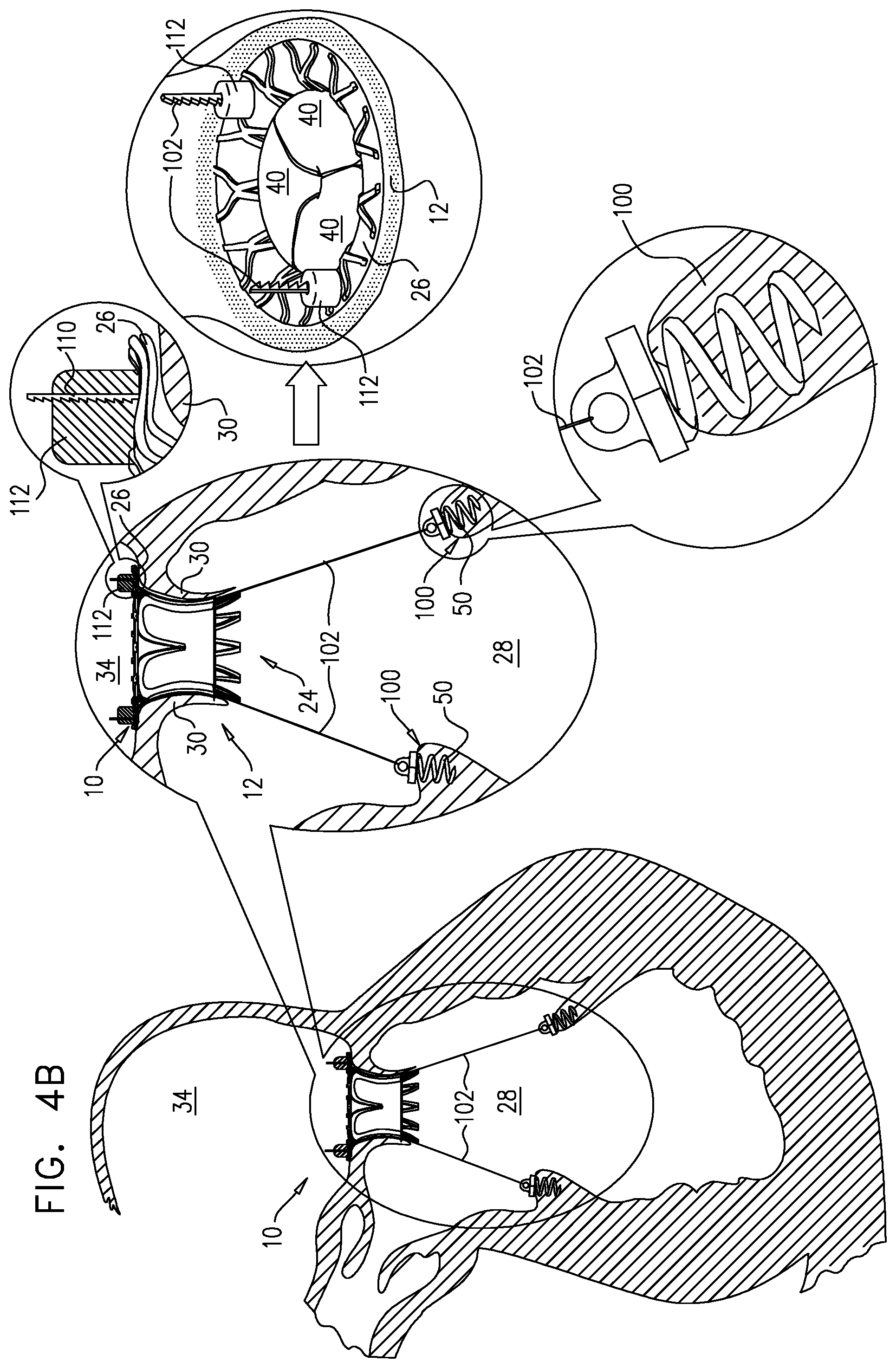 Patent US12167963 Figure 7 – Method for use at a heart valve