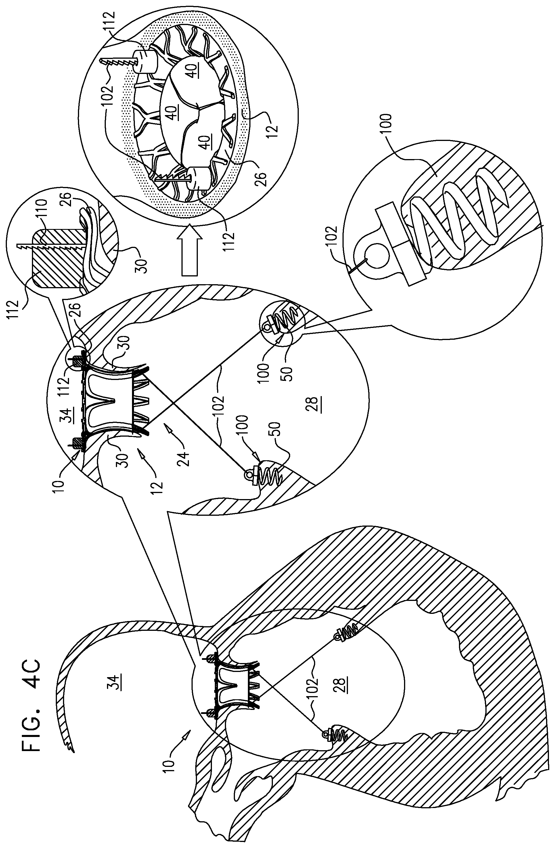 Patent US12167963 Figure 8 – Method for use at a heart valve