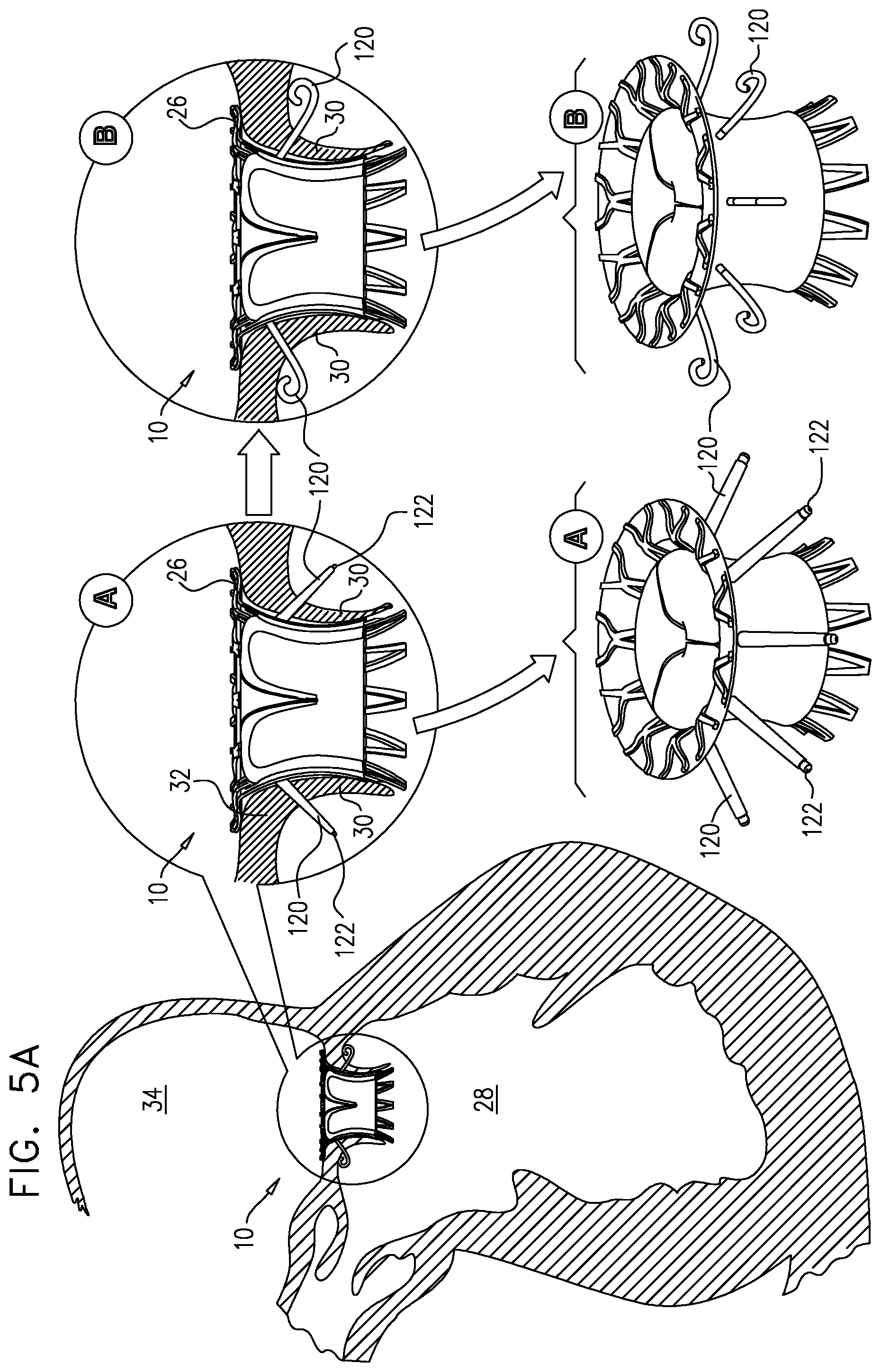 Patent US12167963 Figure 9 – Method for use at a heart valve