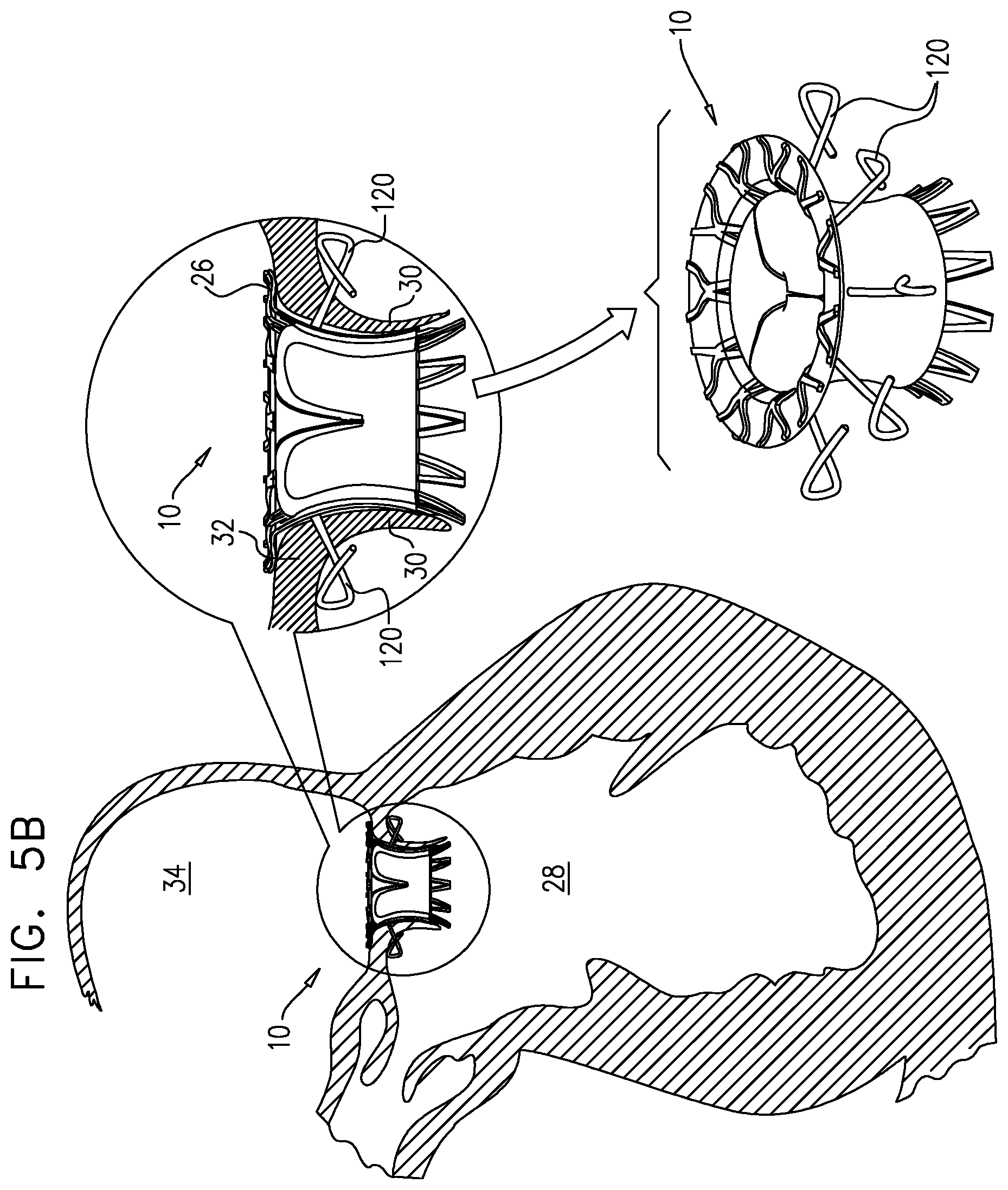 Patent US12167963 Figure 10 – Method for use at a heart valve