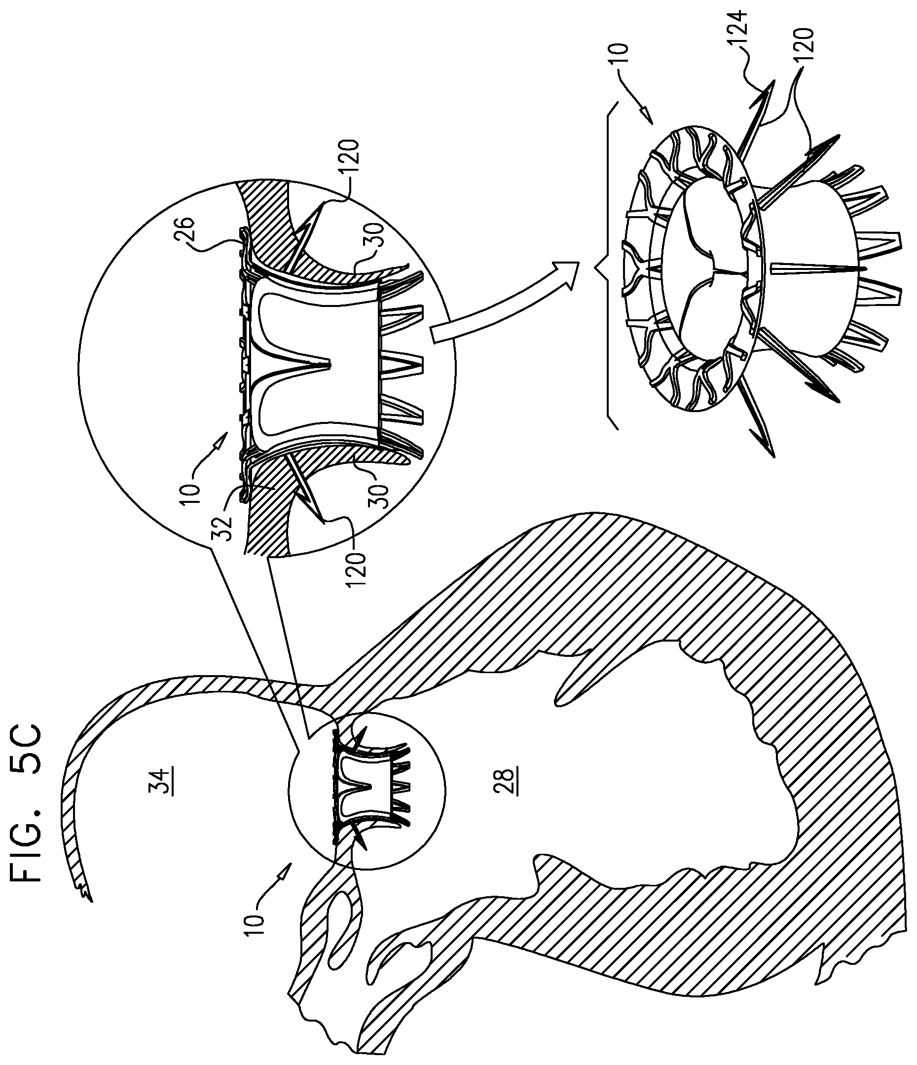 Patent US12167963 Figure 11 – Method for use at a heart valve