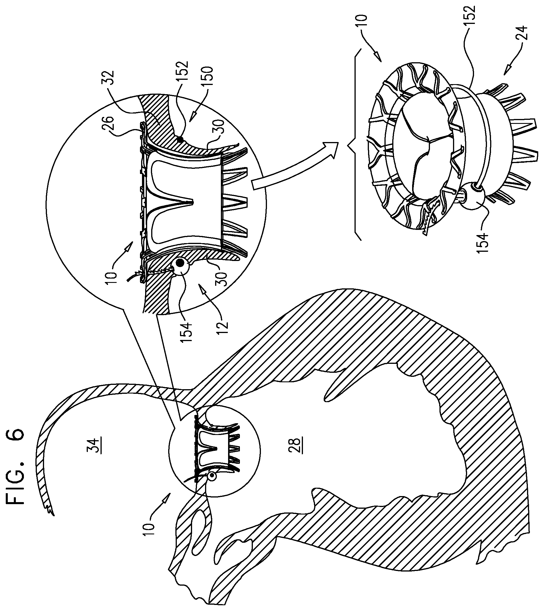 Patent US12167963 Figure 12 – Method for use at a heart valve