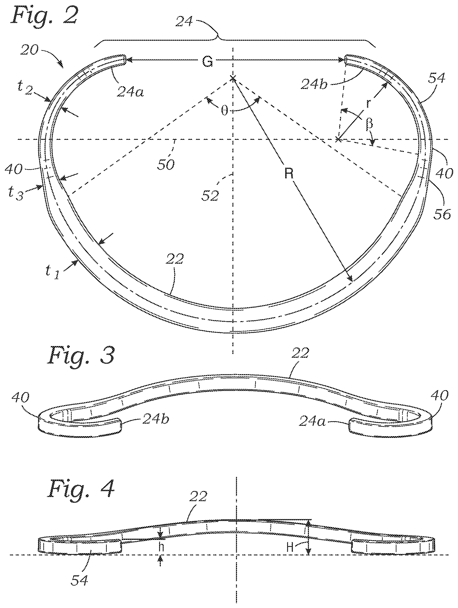 Patent US12167964 Figure 2 – Minimally-invasive low strain annuloplasty ring