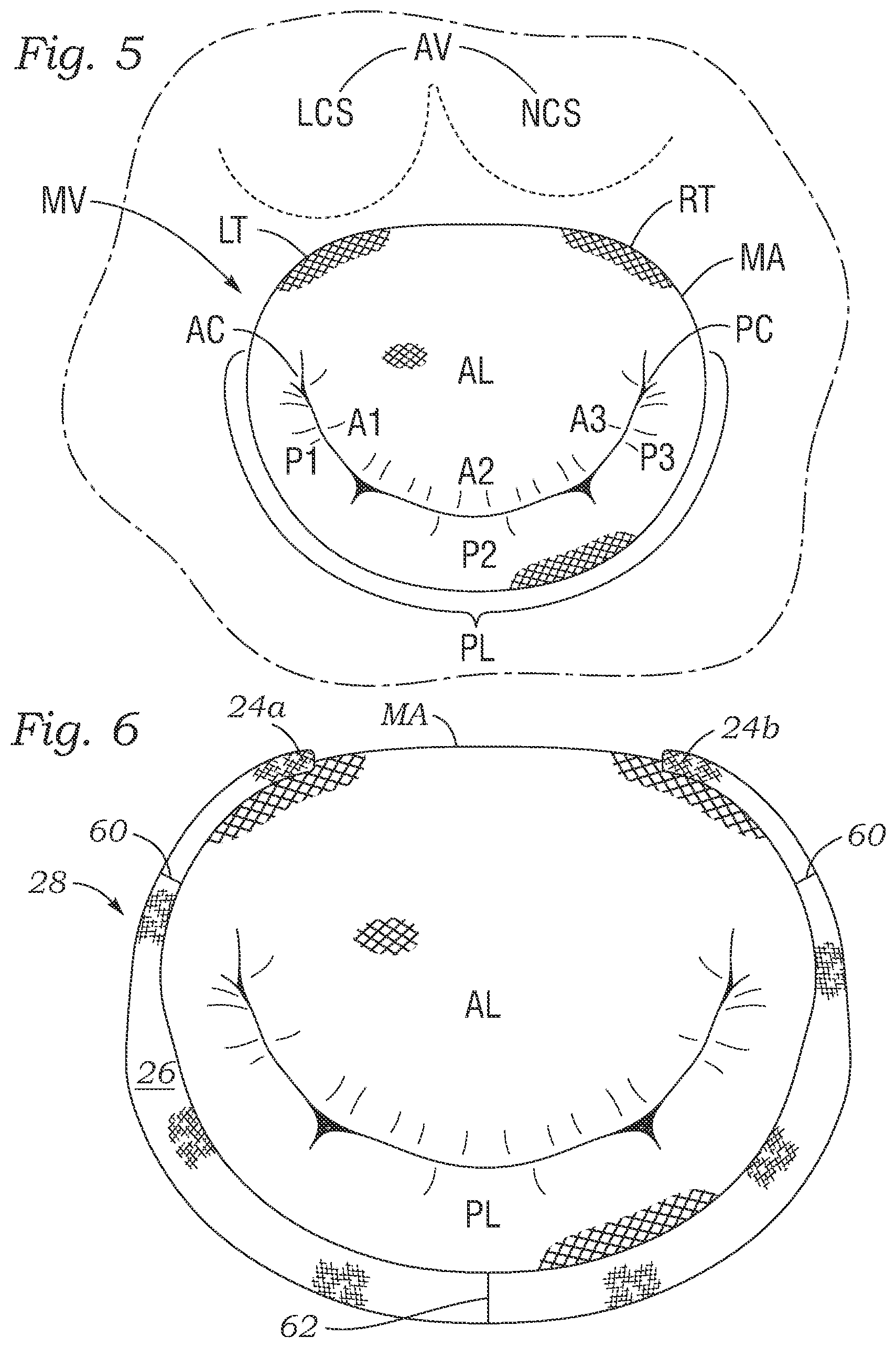 Patent US12167964 Figure 3 – Minimally-invasive low strain annuloplasty ring