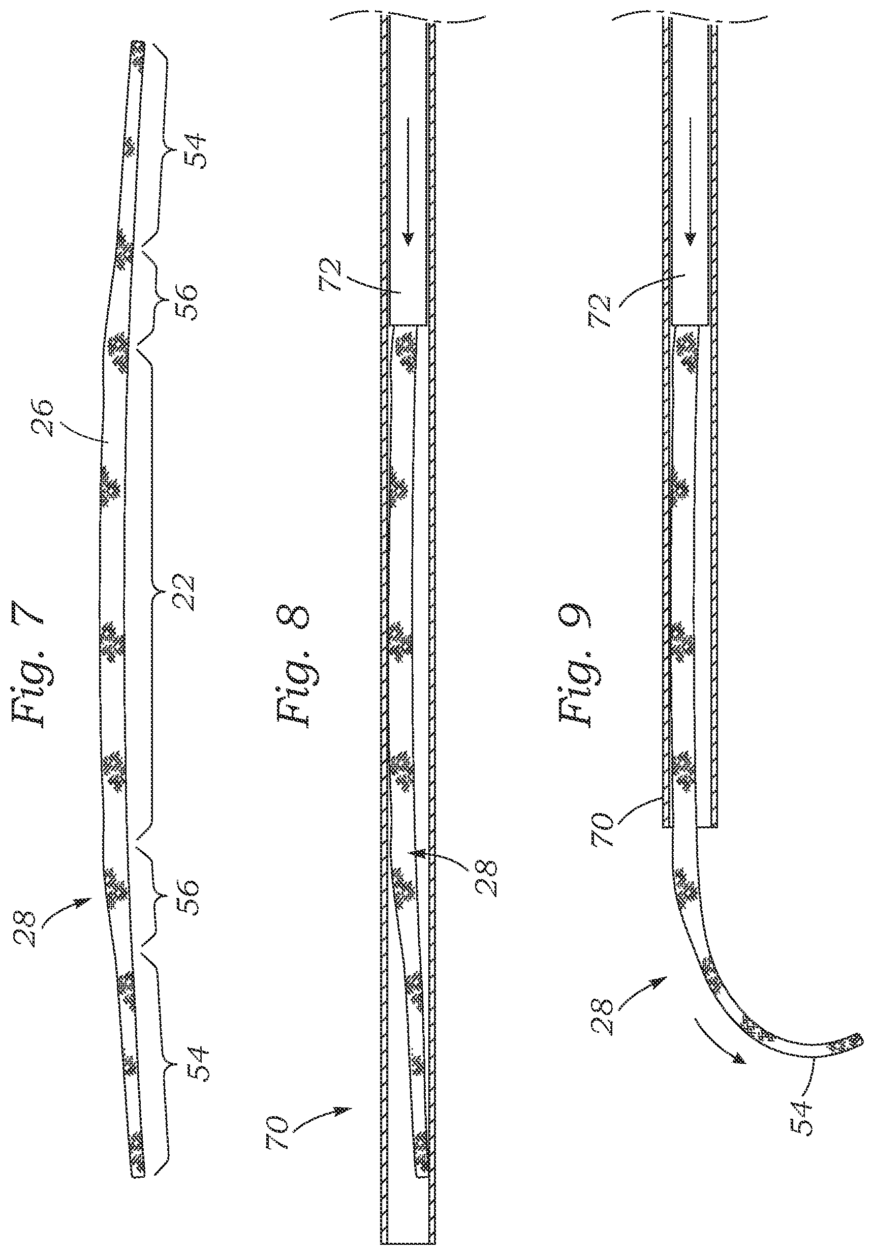 Patent US12167964 Figure 4 – Minimally-invasive low strain annuloplasty ring