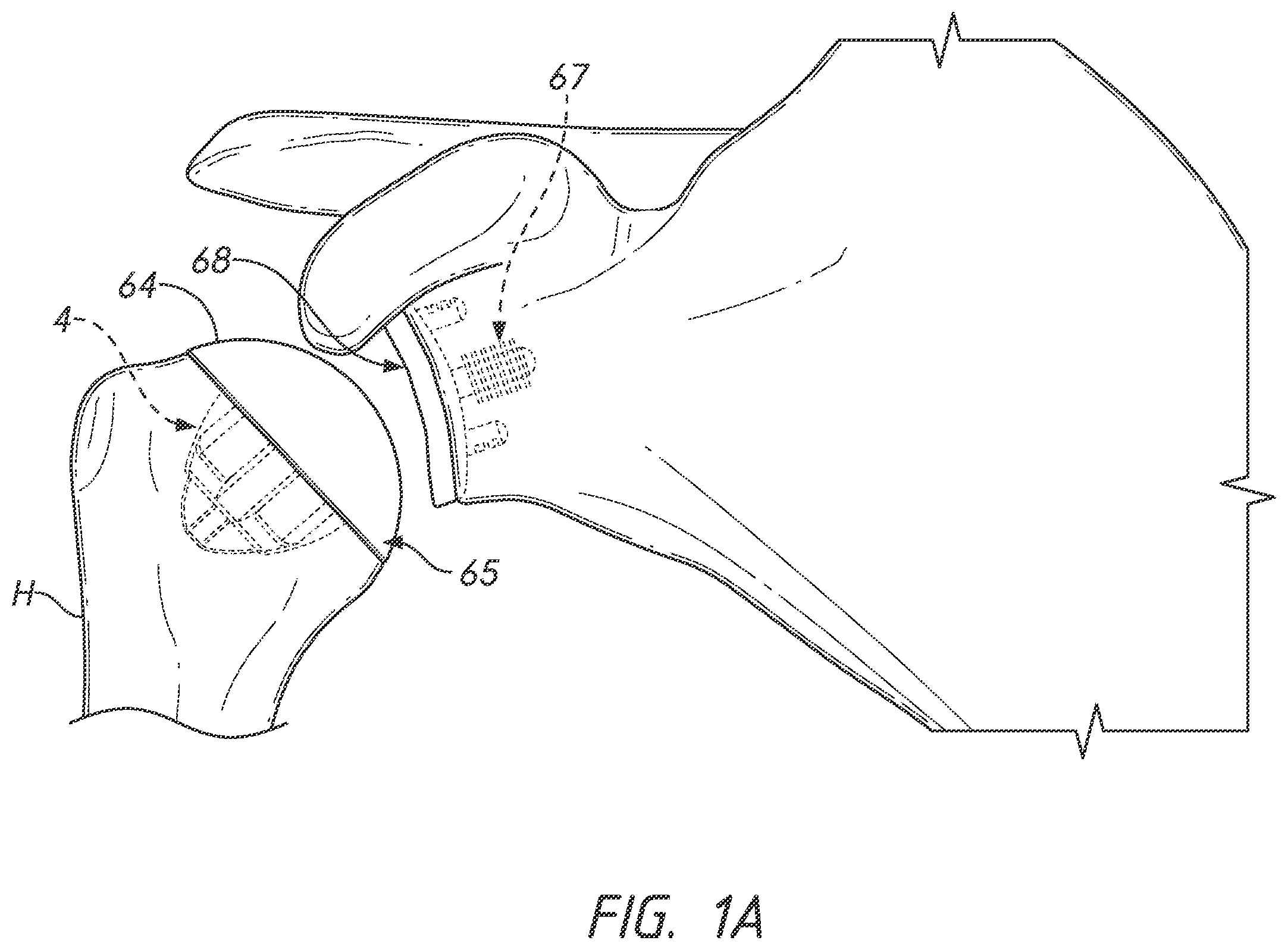 Patent US12167966 Figure 1 – Shoulder prosthesis components and assemblies