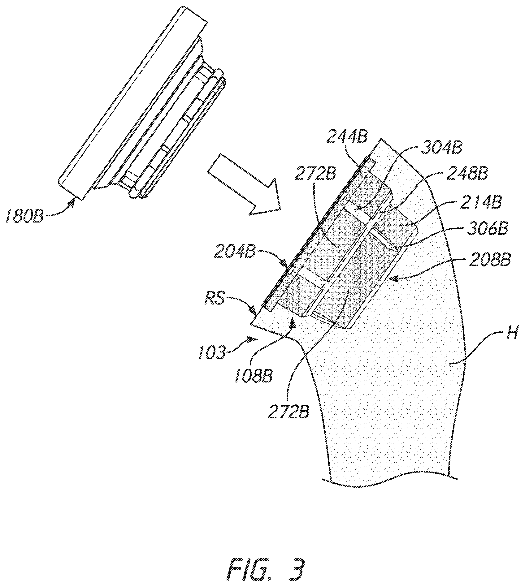 Patent US12167966 Figure 5 – Shoulder prosthesis components and assemblies