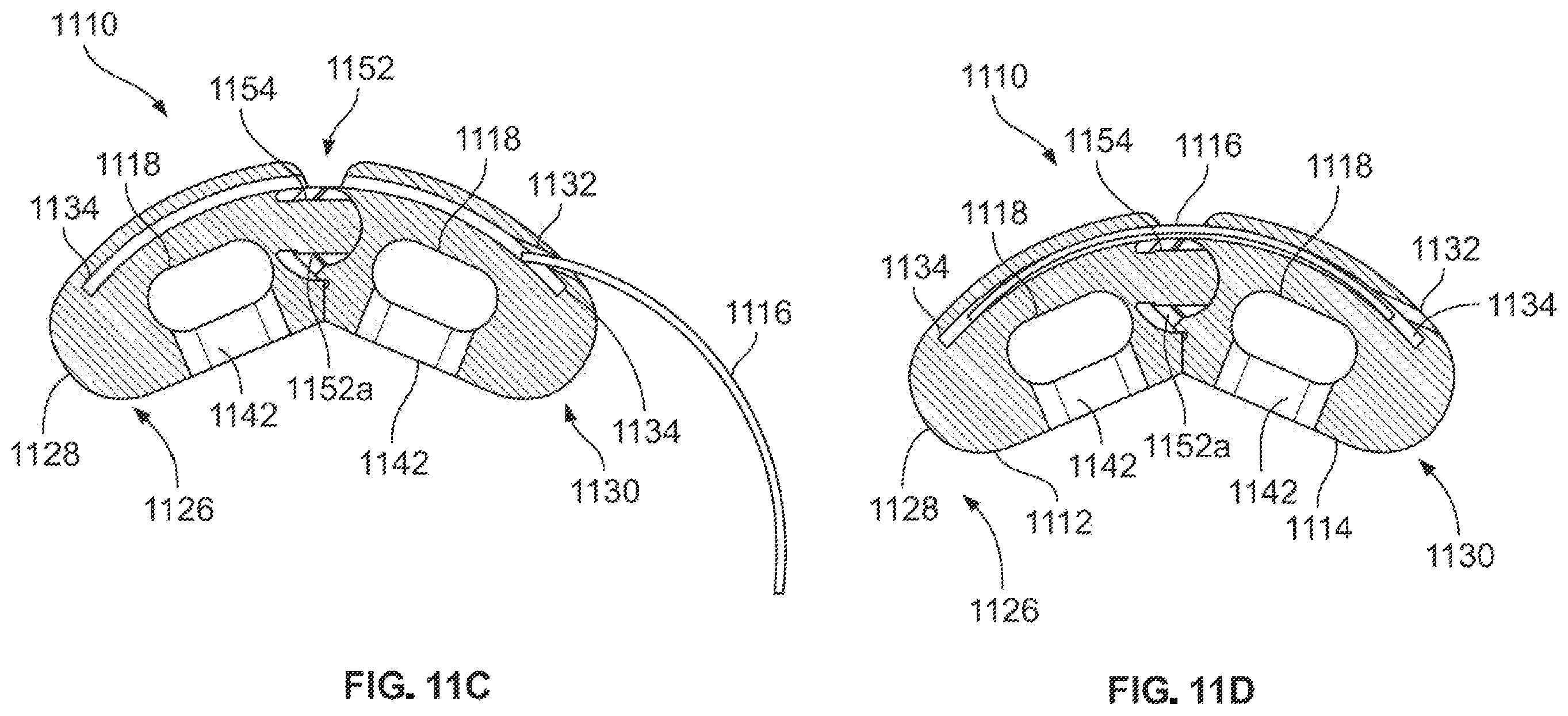 Patent US12167967 Figure 17 – Flexible interbody implant