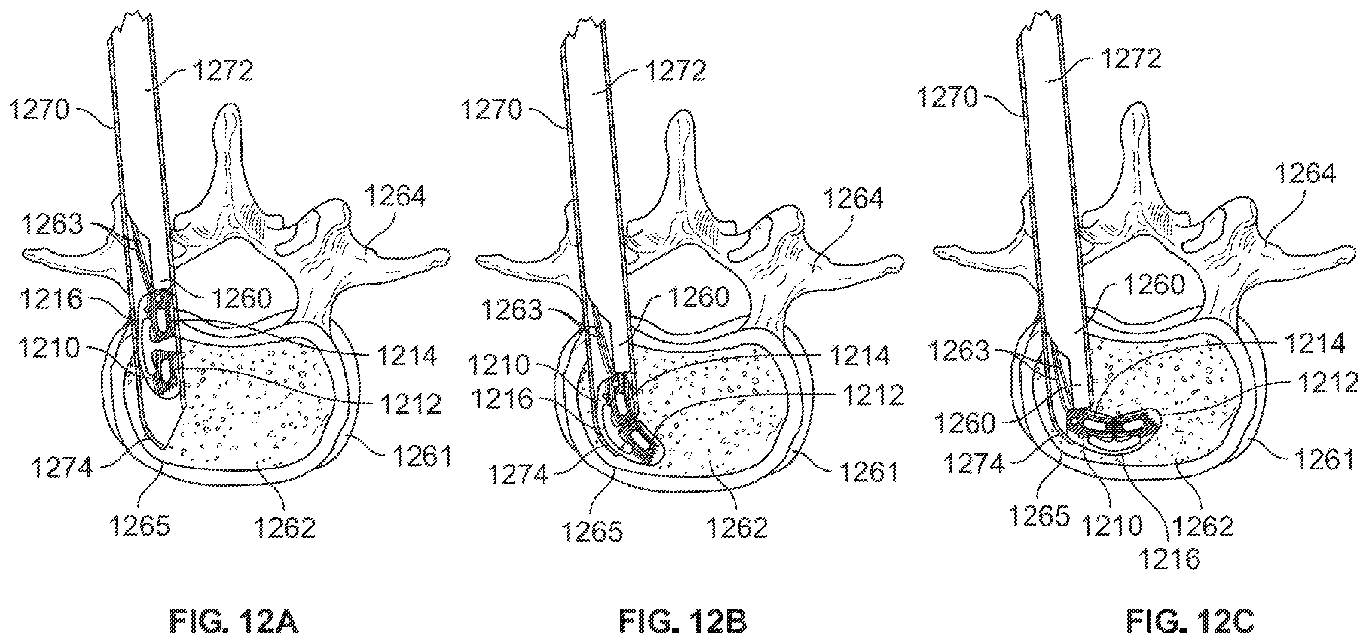 Patent US12167967 Figure 18 – Flexible interbody implant