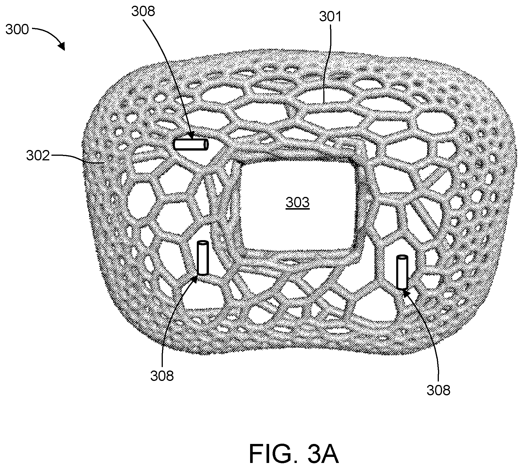 Patent US12167969 Figure 3 – Resonating implant systems and methods