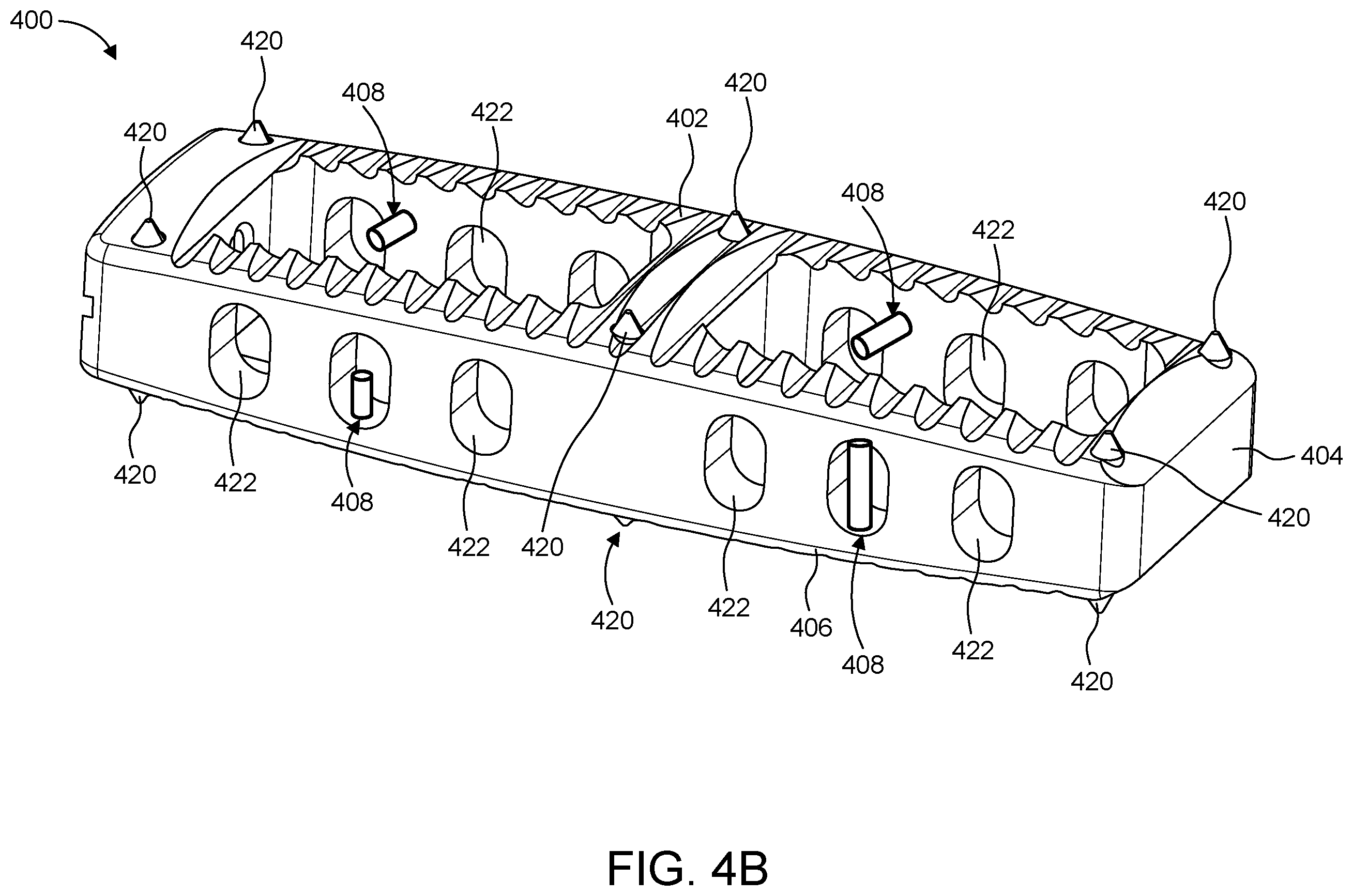 Patent US12167969 Figure 6 – Resonating implant systems and methods