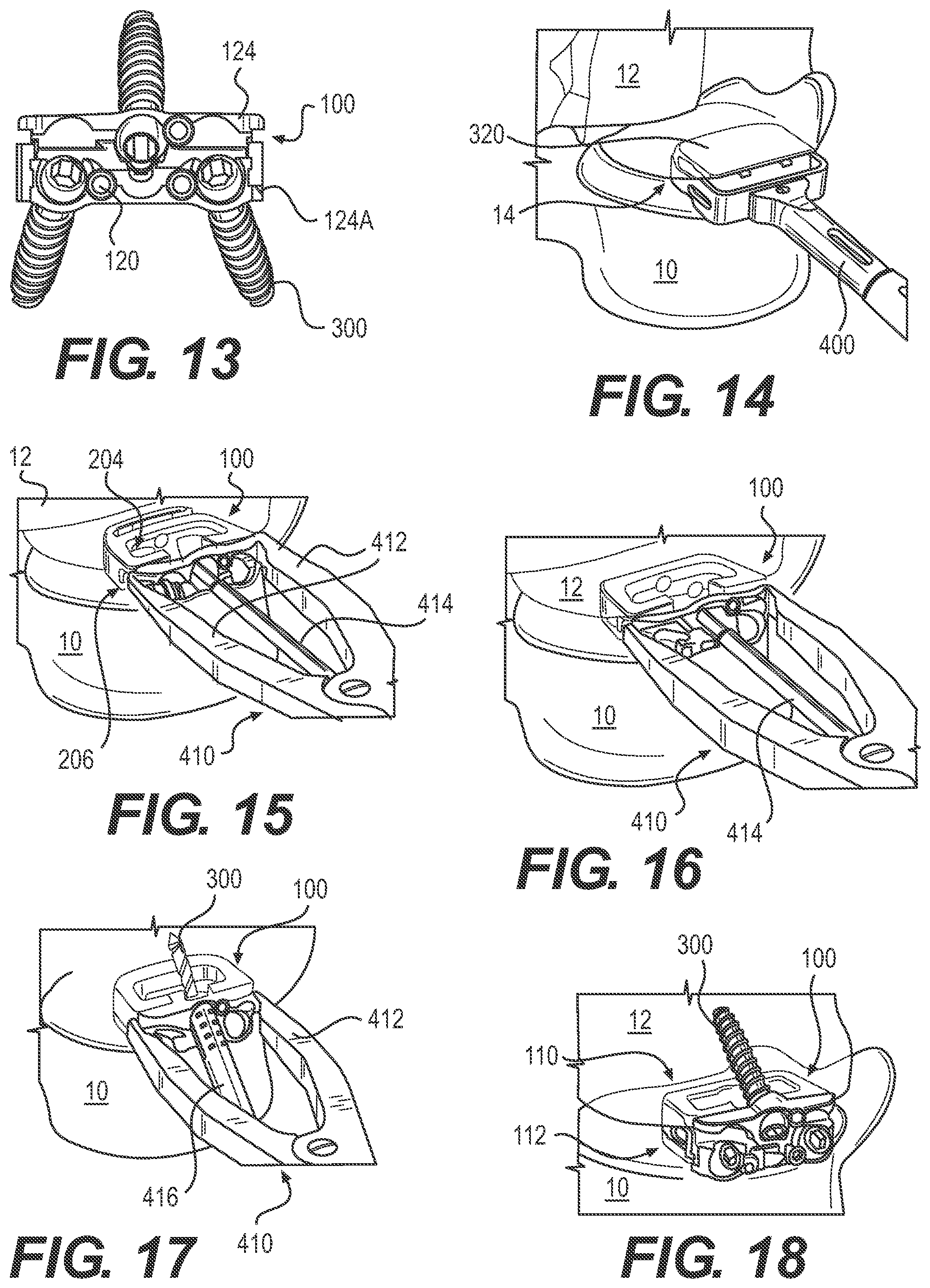 Patent US12167970 Figure 5 – Expandable inter vertebral implant