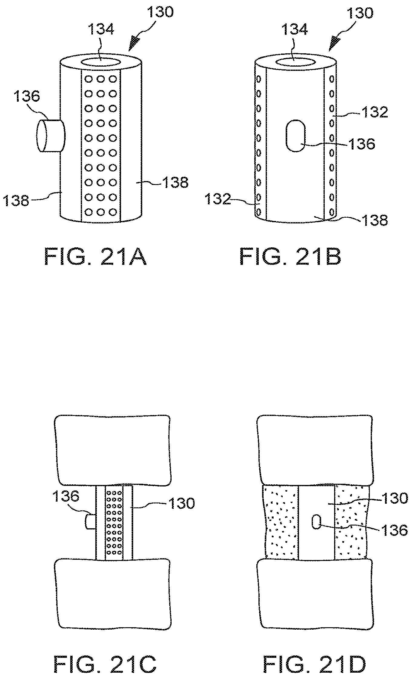 Patent US12167971 Figure 13 – Bone graft delivery devices, systems and kits