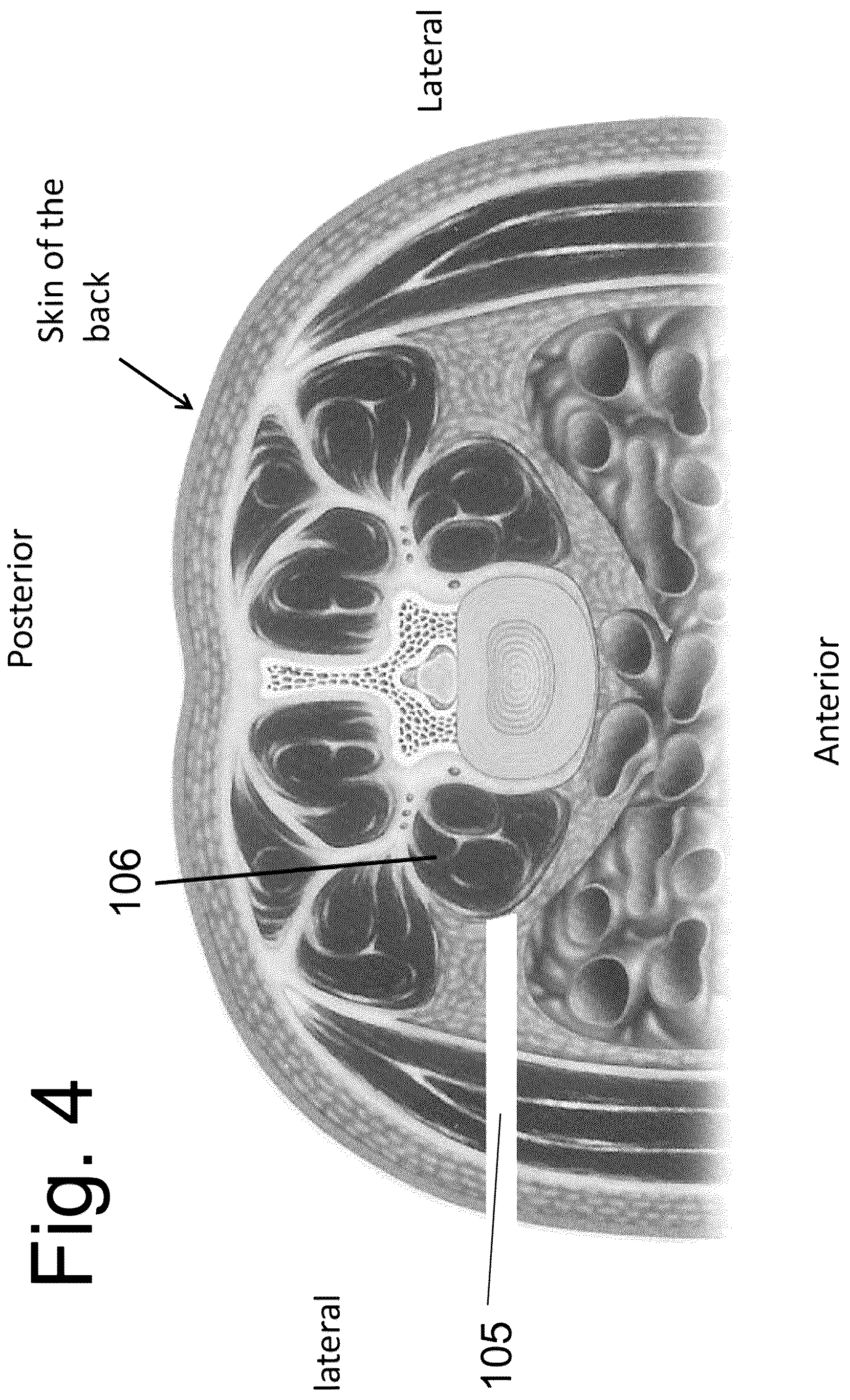 Patent US12167973 Figure 4 – Spinal fixation devices and methods of use