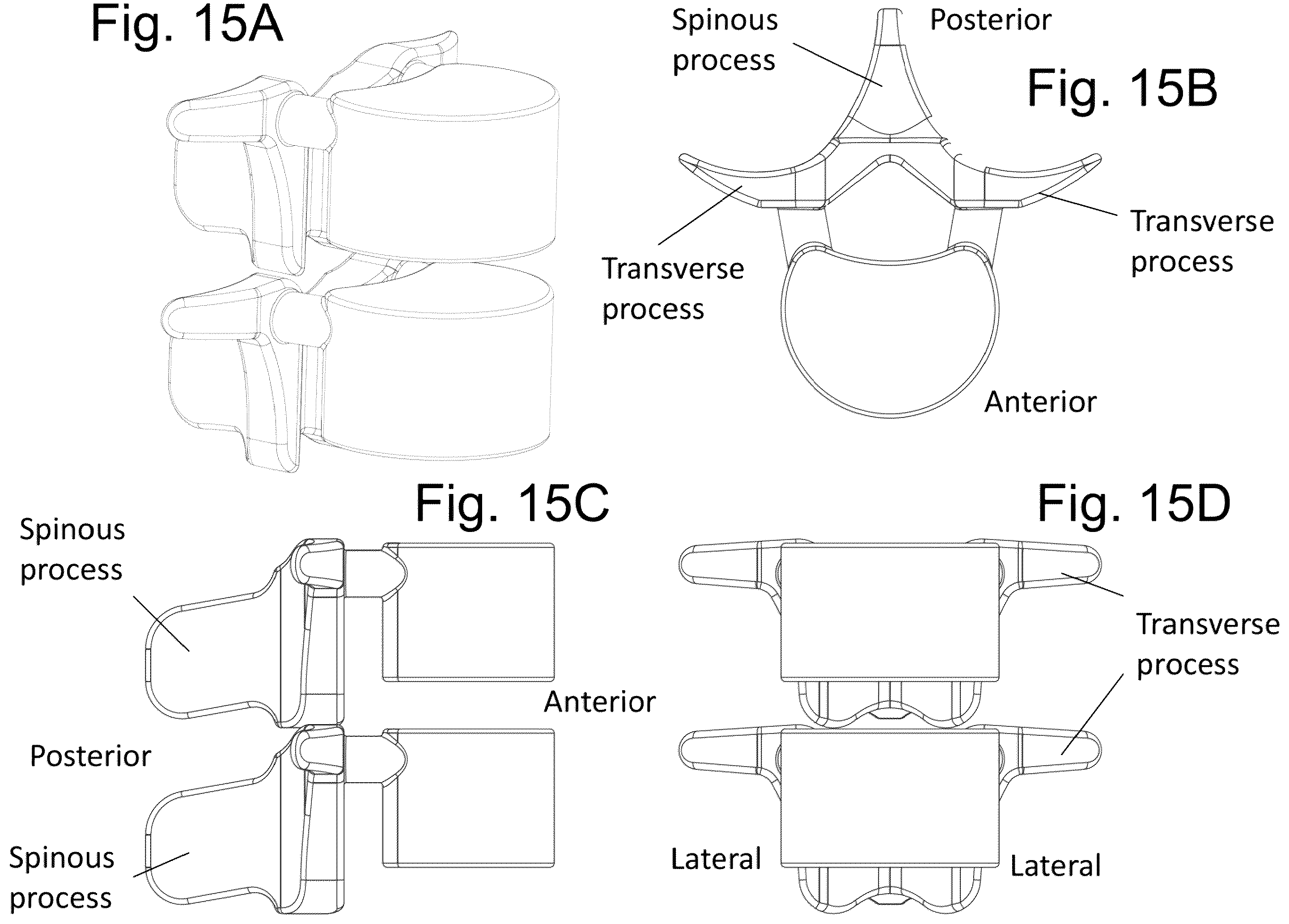 Patent US12167973 Figure 15 – Spinal fixation devices and methods of use