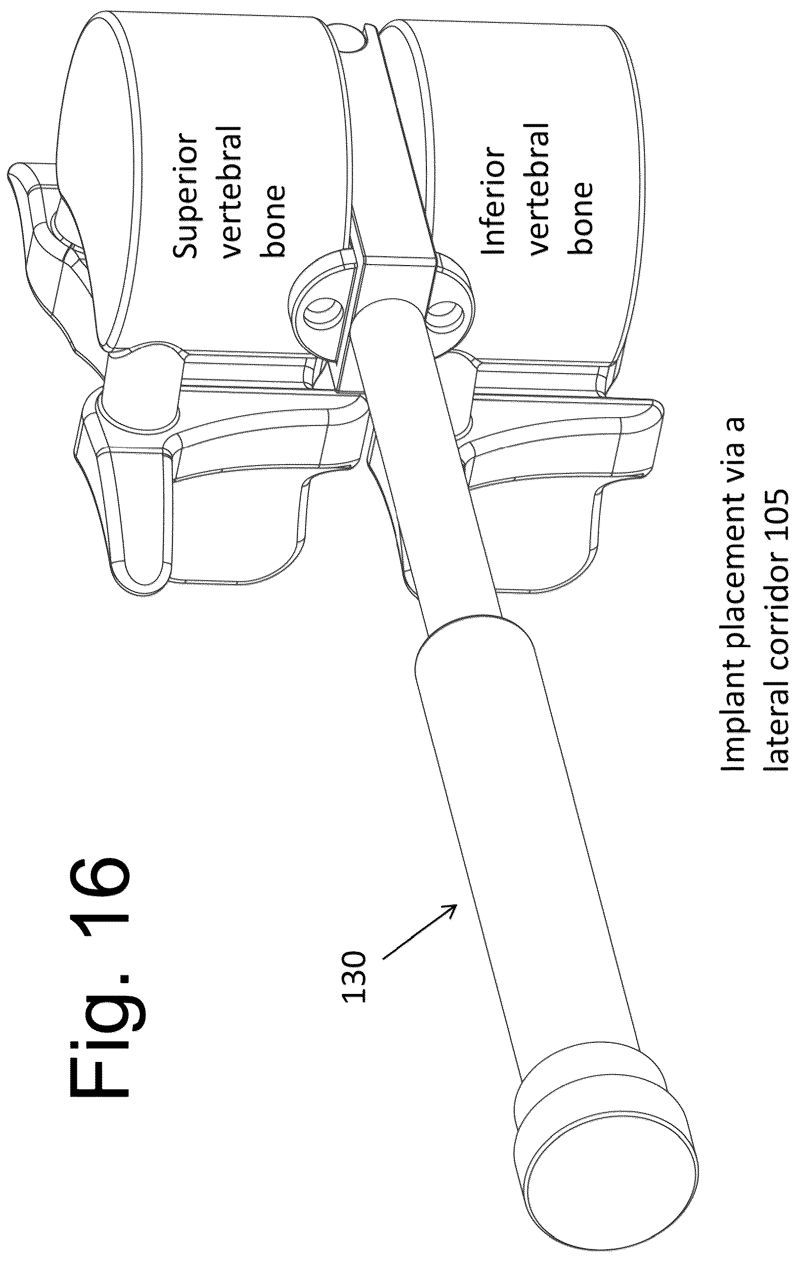 Patent US12167973 Figure 16 – Spinal fixation devices and methods of use