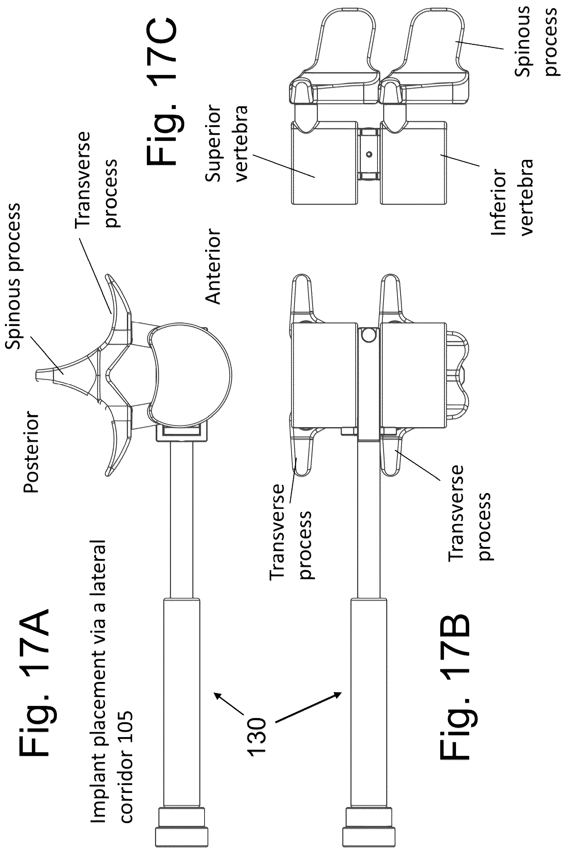 Patent US12167973 Figure 17 – Spinal fixation devices and methods of use